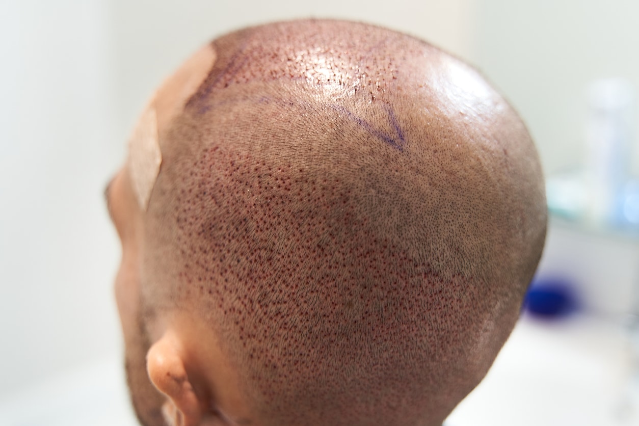 Invisible Scars? The Truth About Modern Hair Transplant Techniques