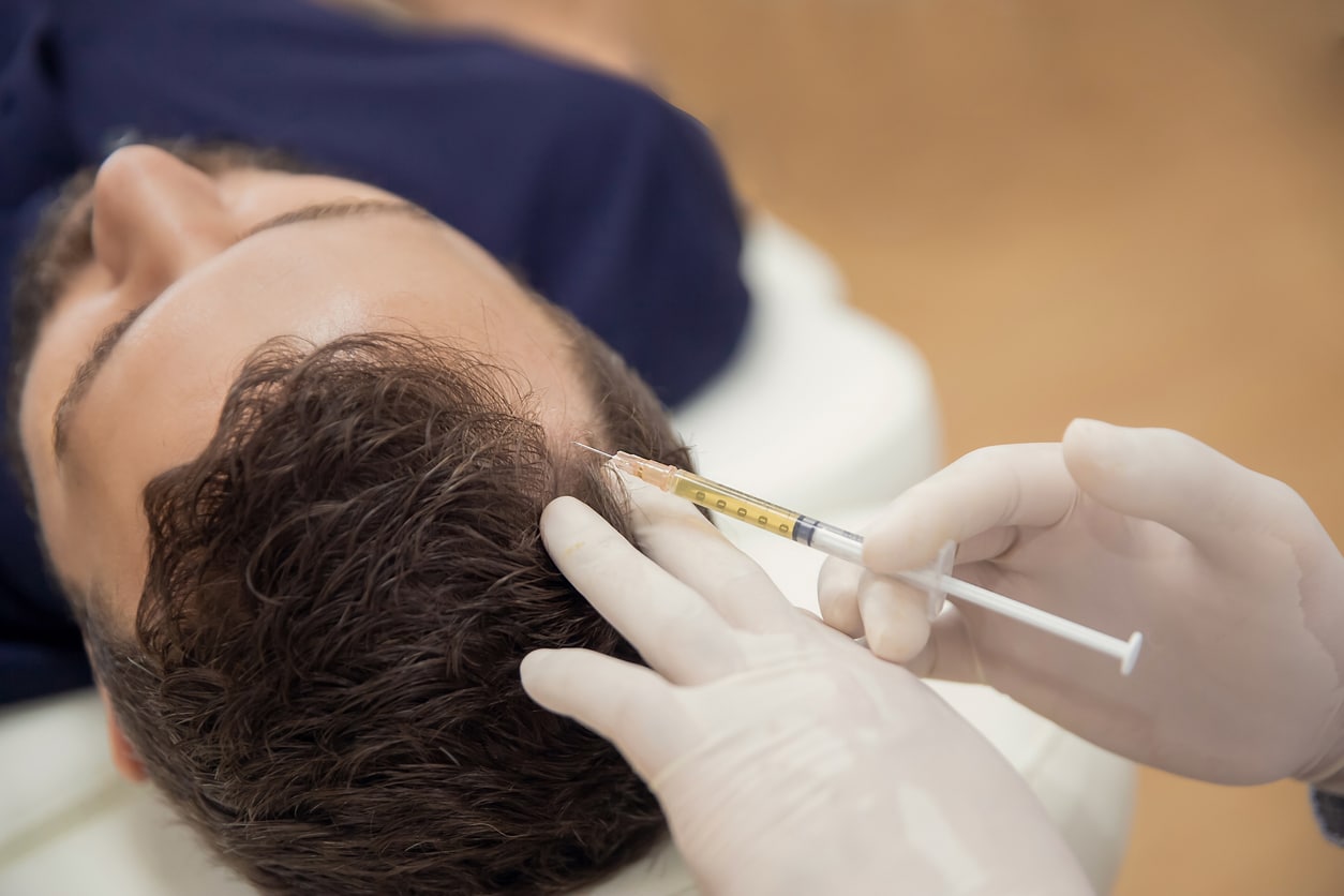 What Is Platelet-Rich Plasma or PRP Therapy for Hair Restoration? Benefits, Process & Results Explained