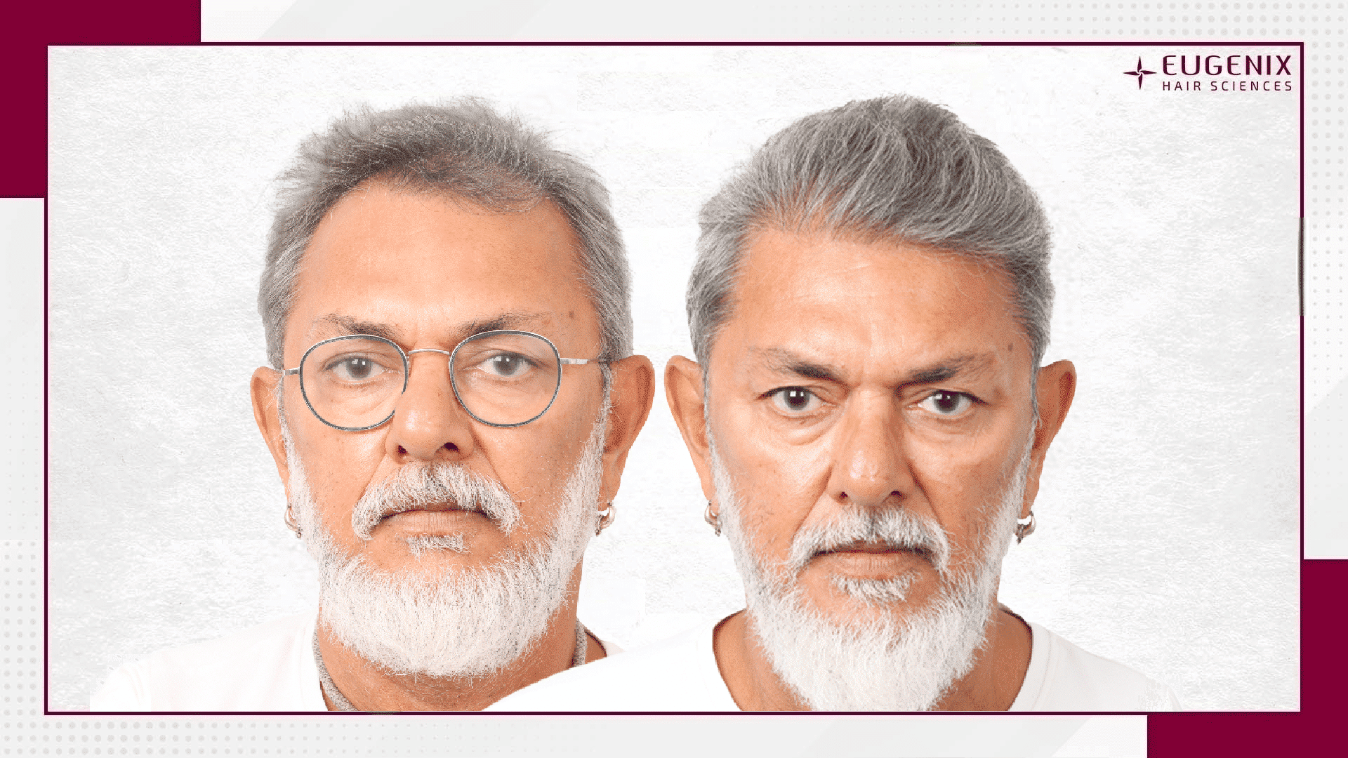 Rakeysh Omprakash Mehra - Hair Transplant-1