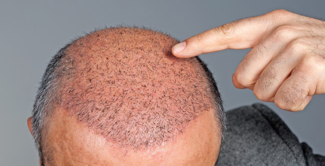 Temporary Shedding After Your Hair Transplant? It’s Normal – and a Sign of Growth Ahead!