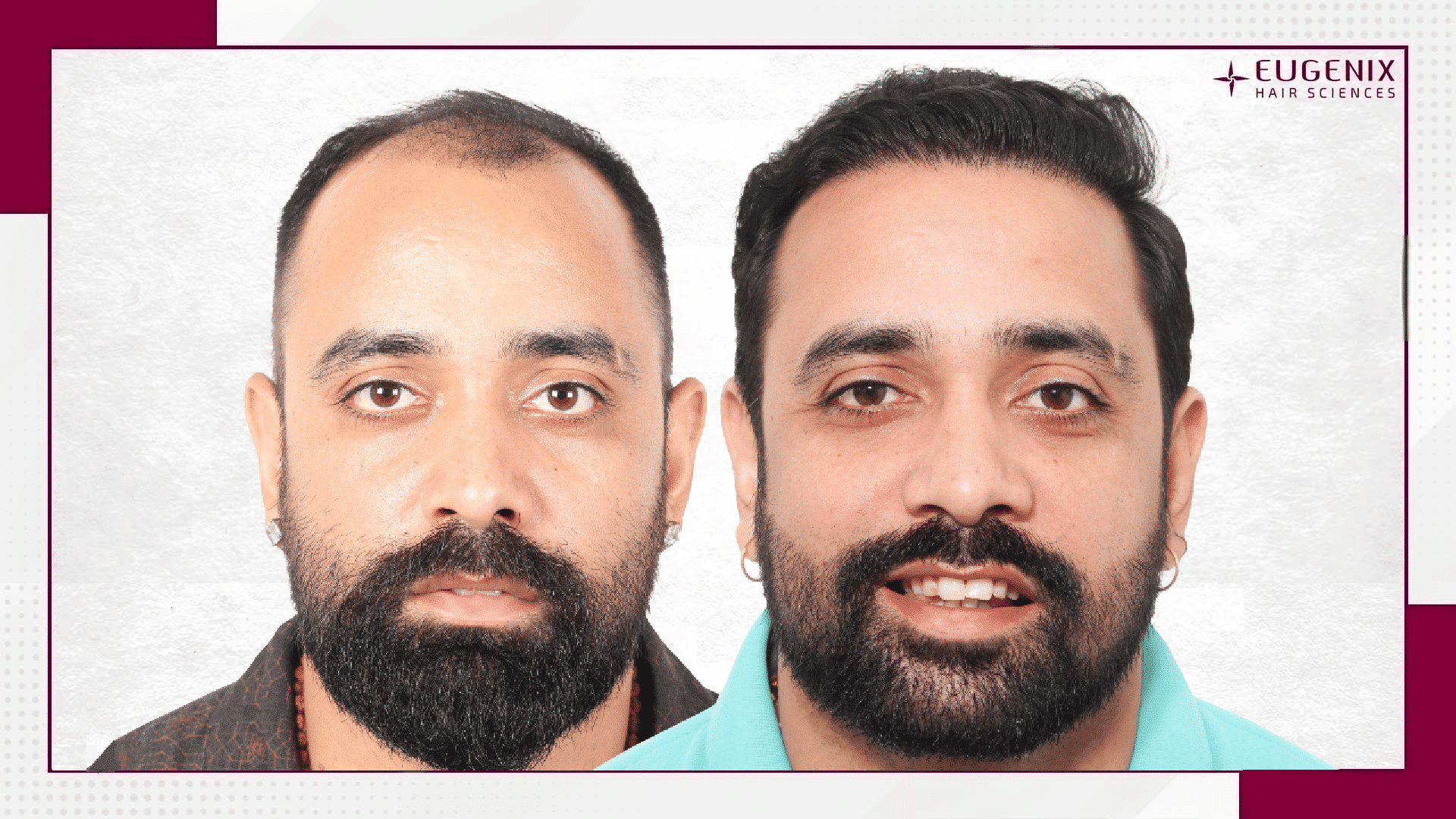 Vishesh Bhriguvanshi - Hair Transplant-1