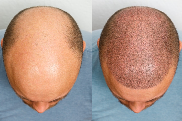 Yes, You Can Still Lose Hair After a Hair Transplant – But You Can Also Stop It
