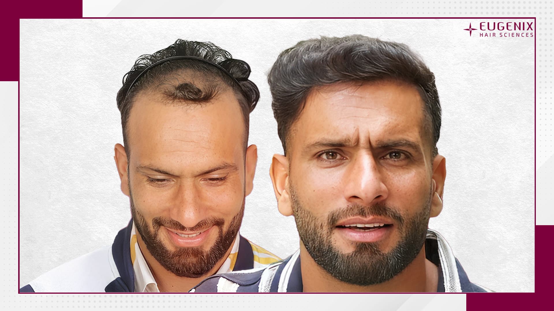 Farid-Malik-Hair-Transplant (1)