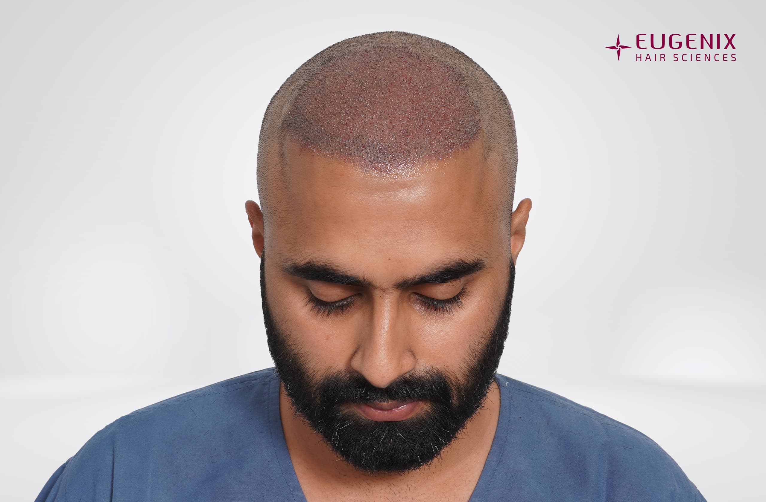 Tushar Naidu Post-op Head Down copy