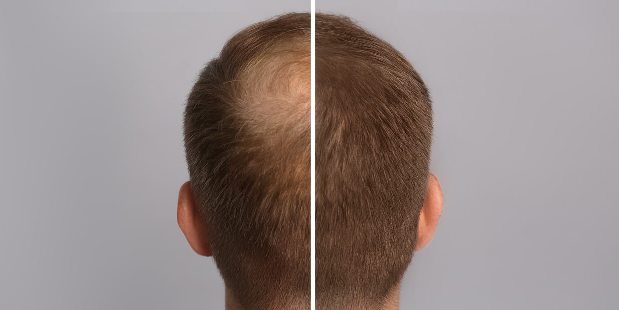 Hair Transplant Safety: What Makes a Clinic Trustworthy?
