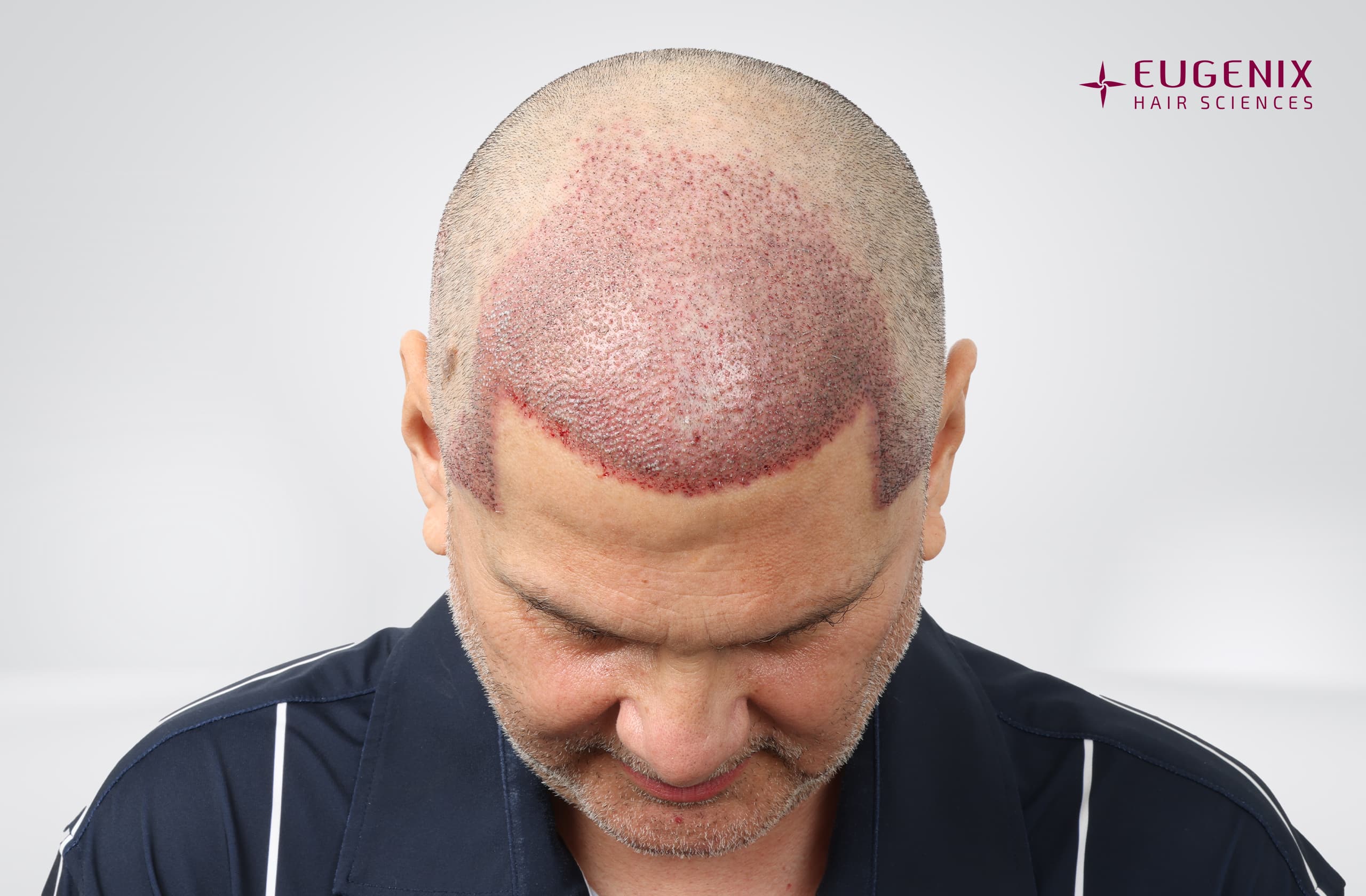 Andre Timmins Post-op Head Down copy