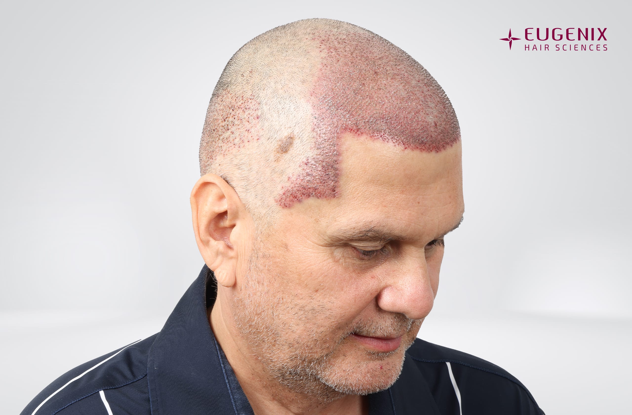 Andre Timmins Post-op Right copy