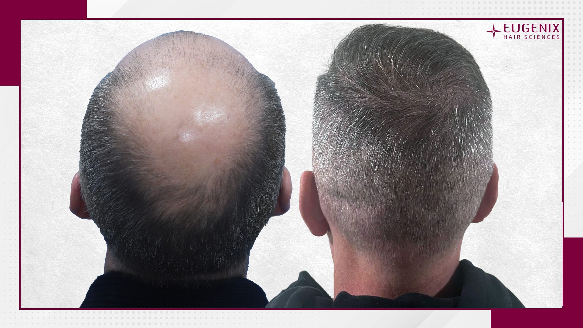 KW-Crown-After-and-Before