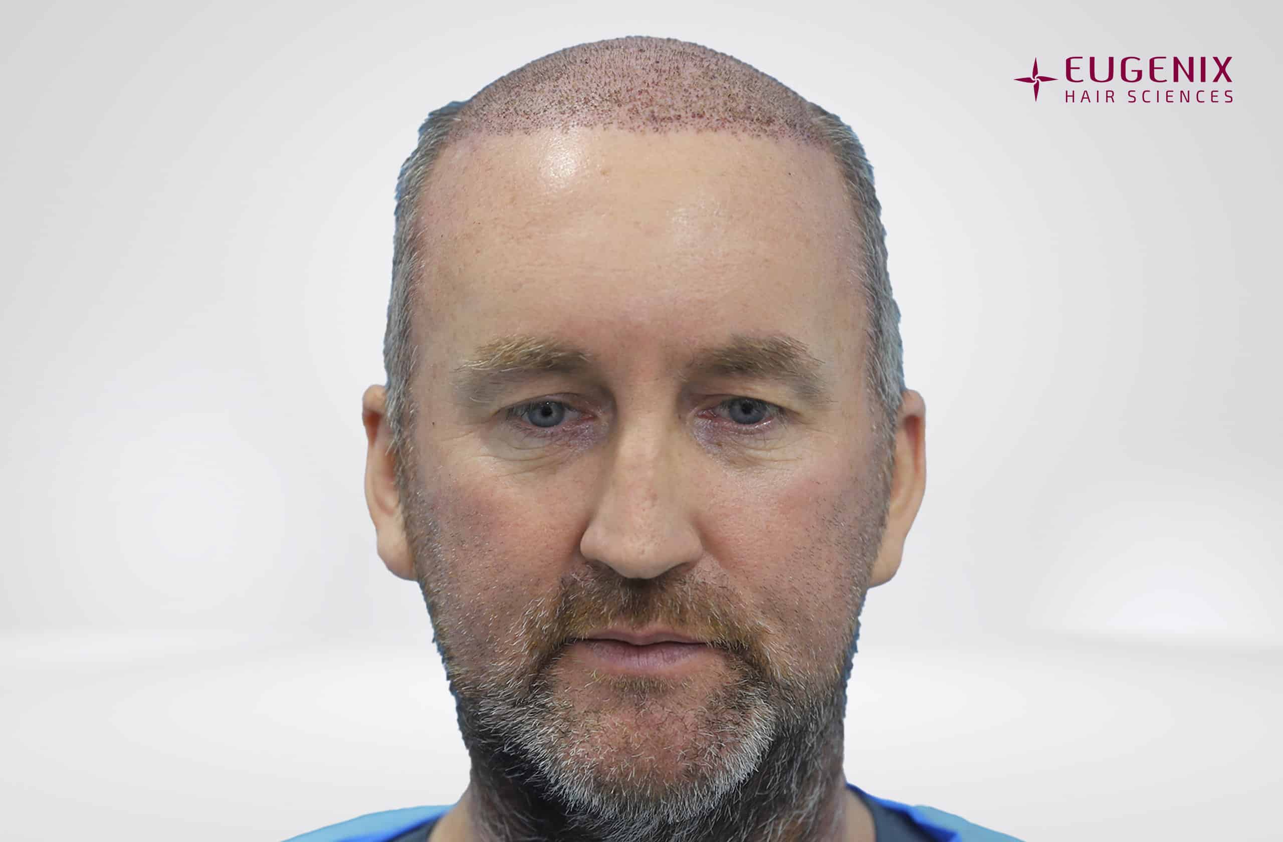 KW Front Post-op