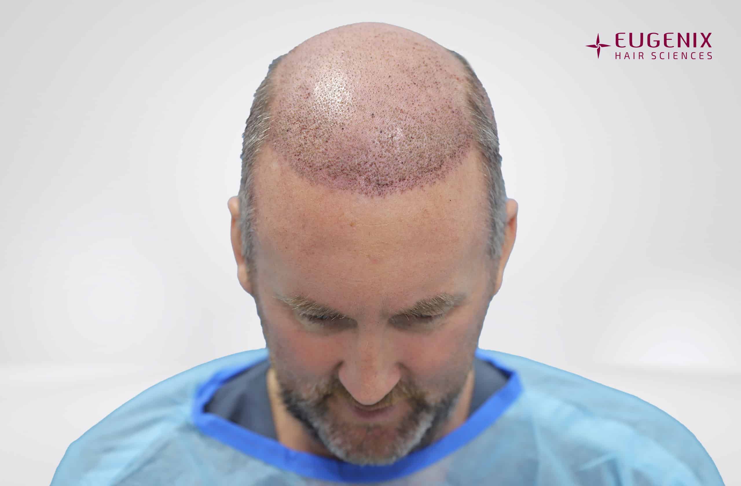 KW Head Down Post-op