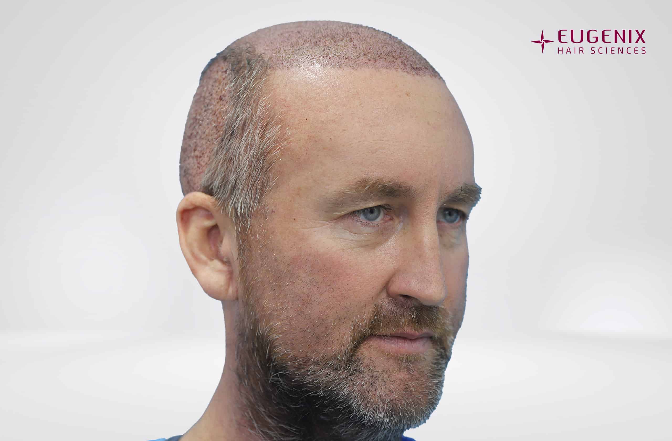 KW Left Post-op