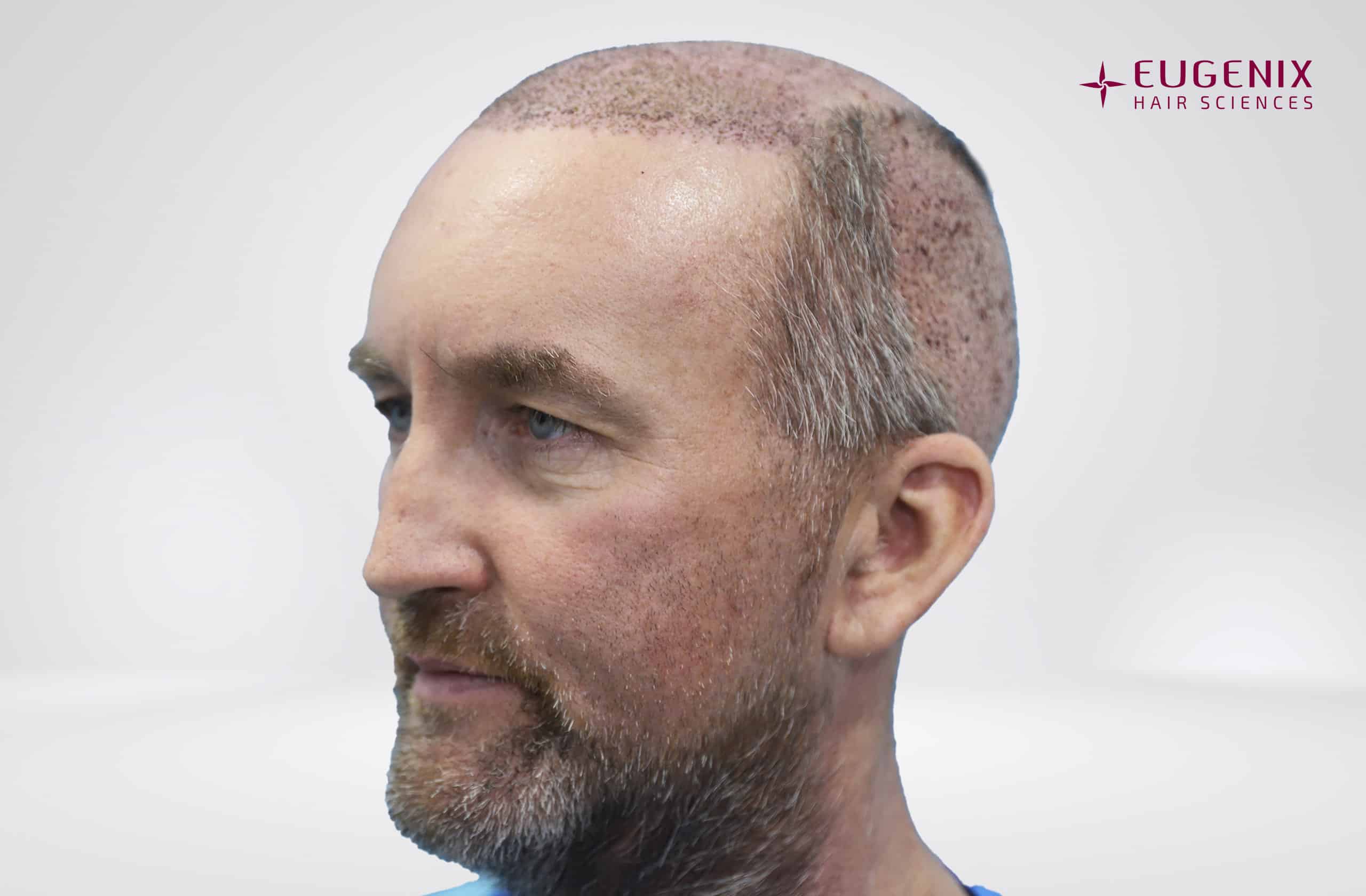 KW Right Post-op