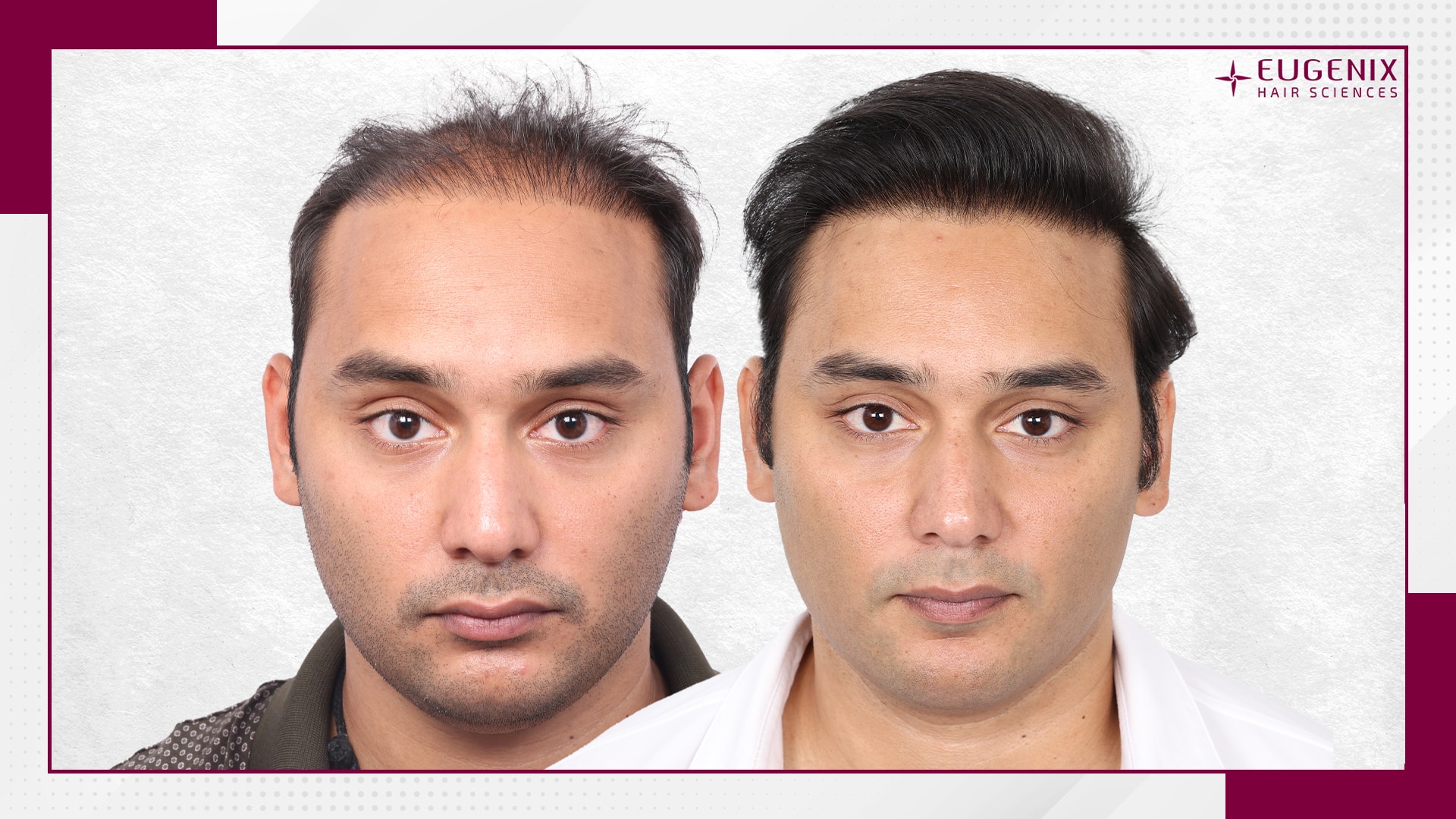 Mohammad Asaduddin Front Before and After copy