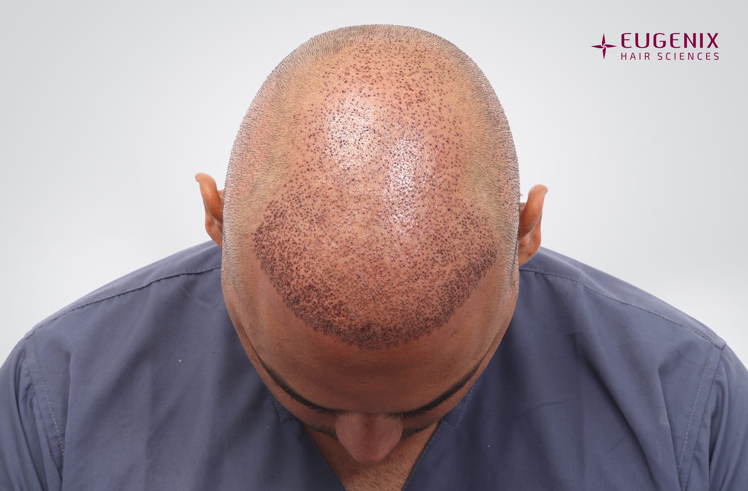 Mohammad Asaduddin Post-op Head Down copy