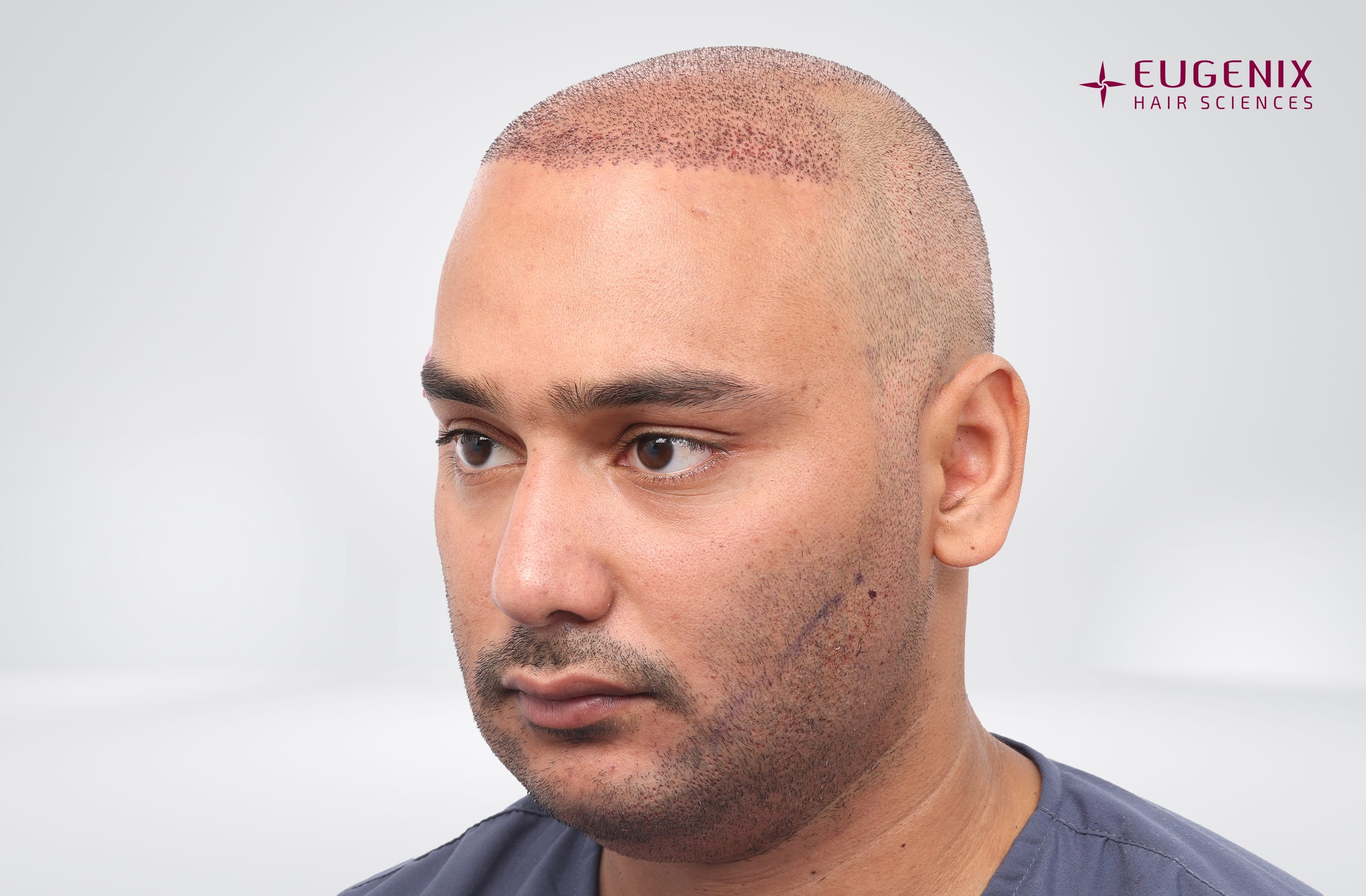 Mohammad Asaduddin Post-op Right copy