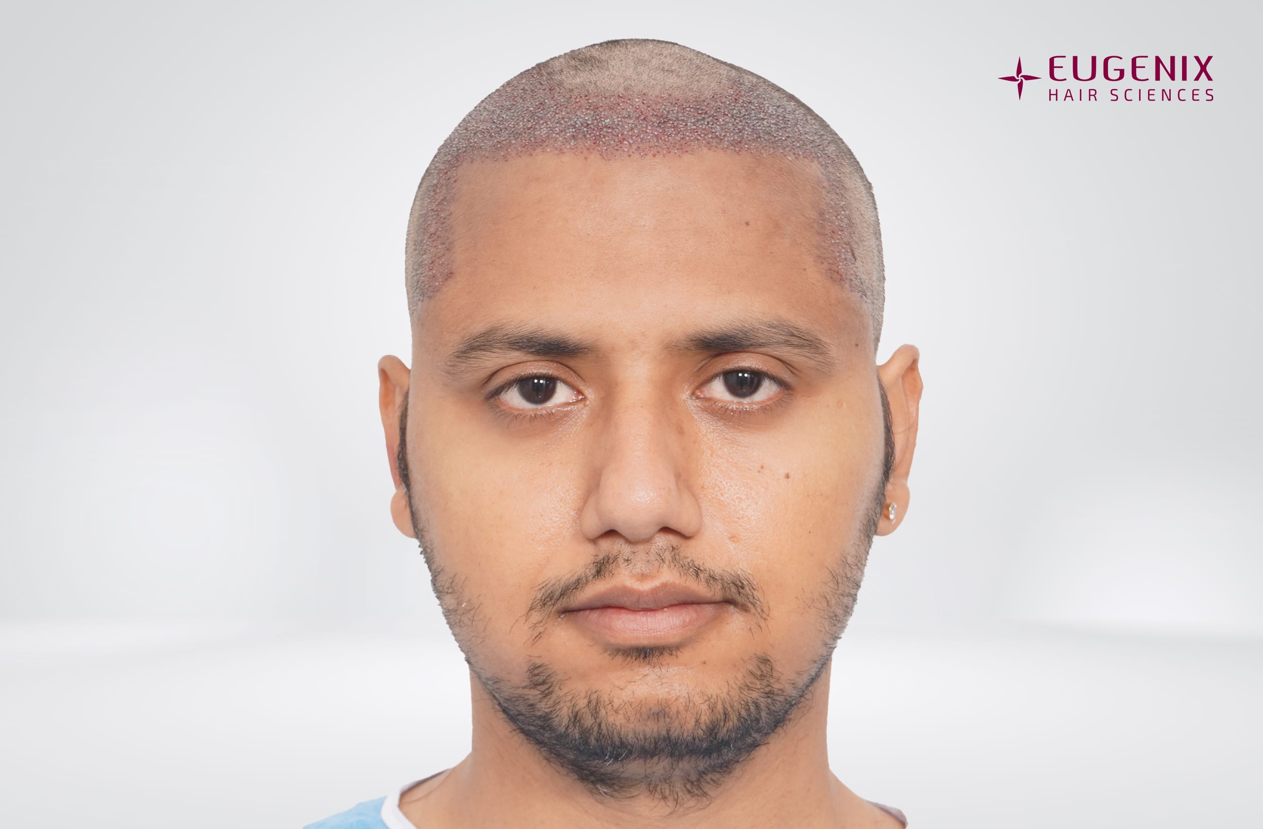 Rajesh Yadav Post-op Front copy