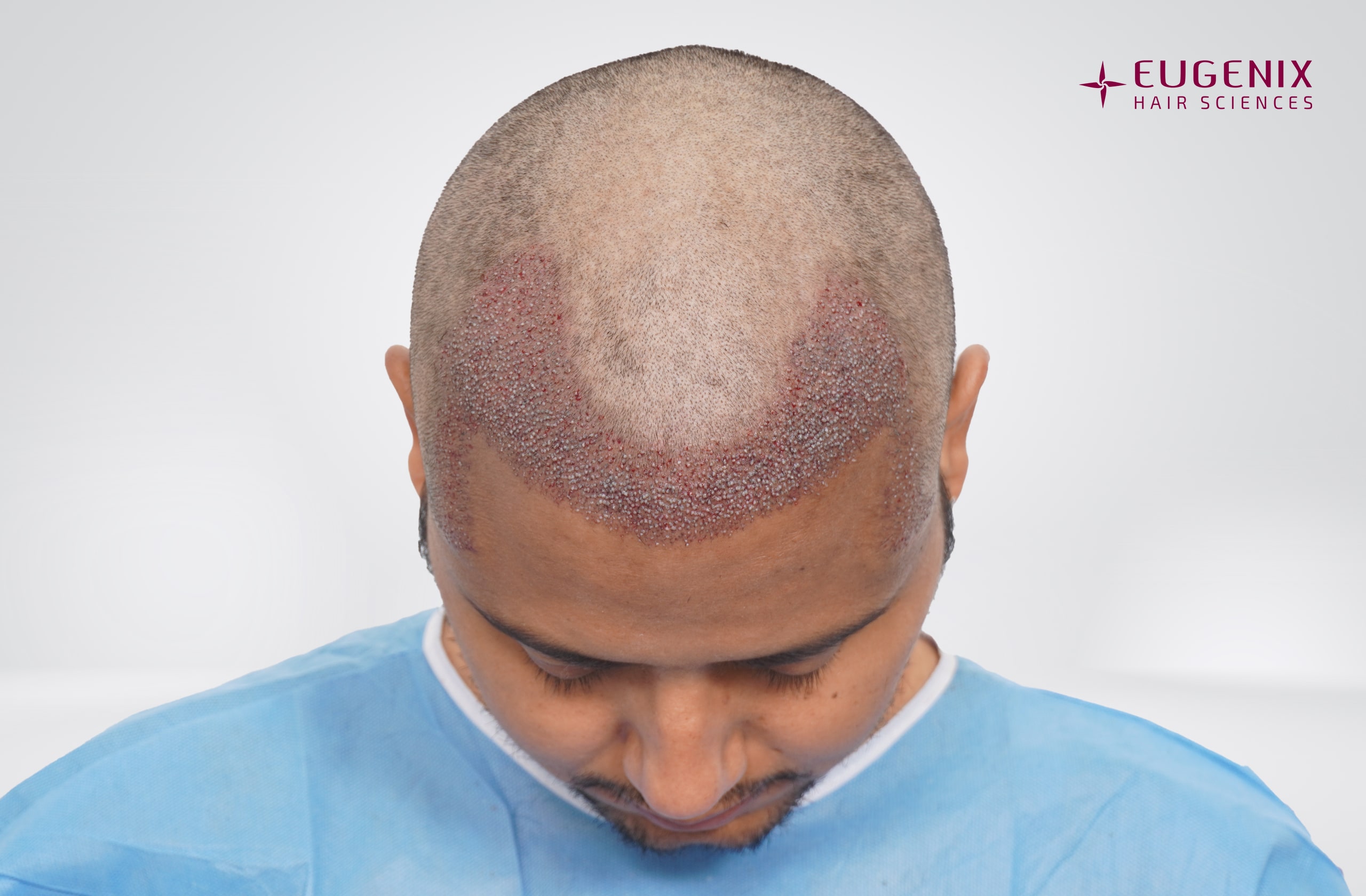 Rajesh Yadav Post-op Head Down copy