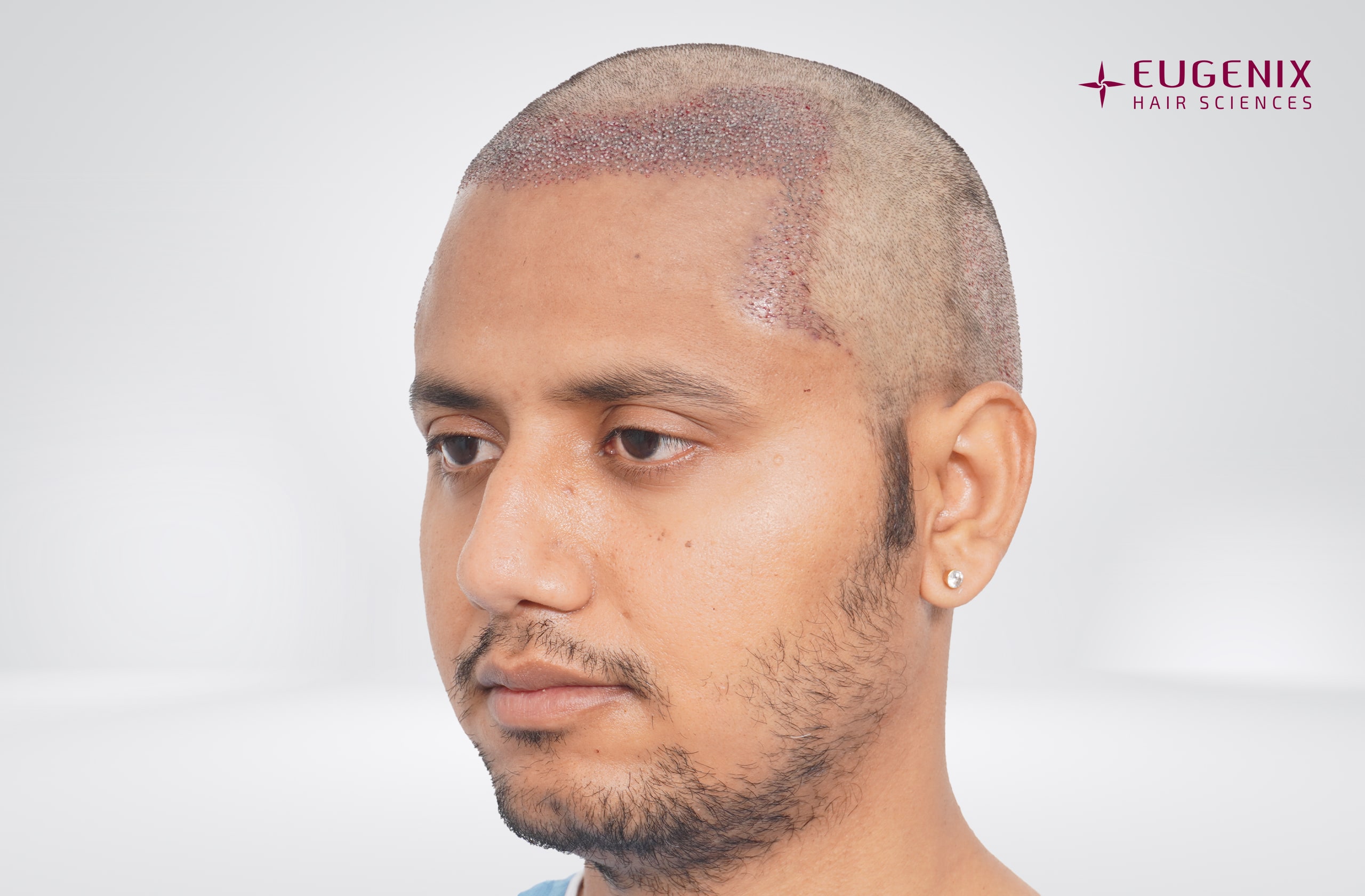 Rajesh Yadav Post-op Right copy