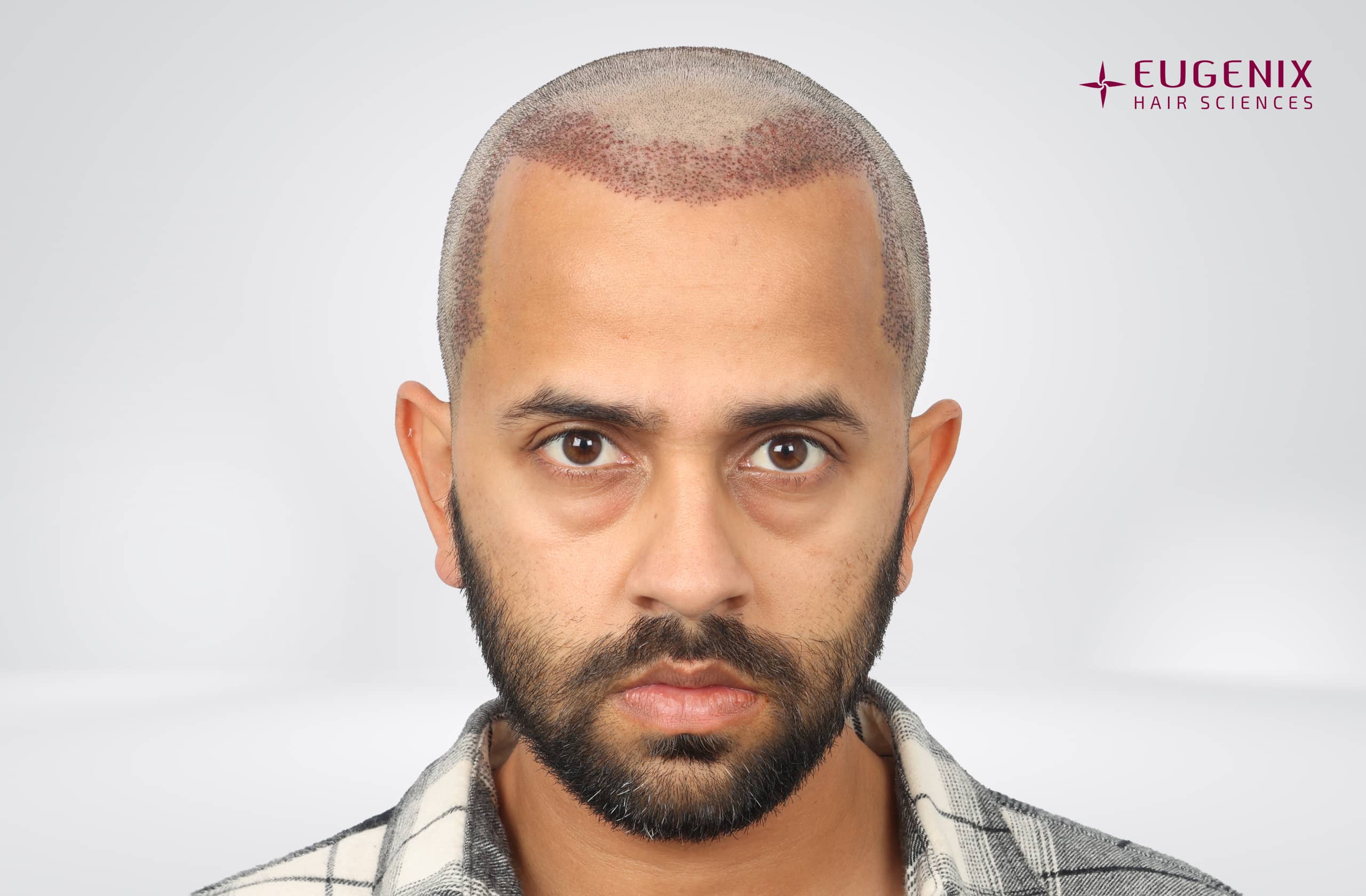 Mihir Gandhi Post-op Front copy
