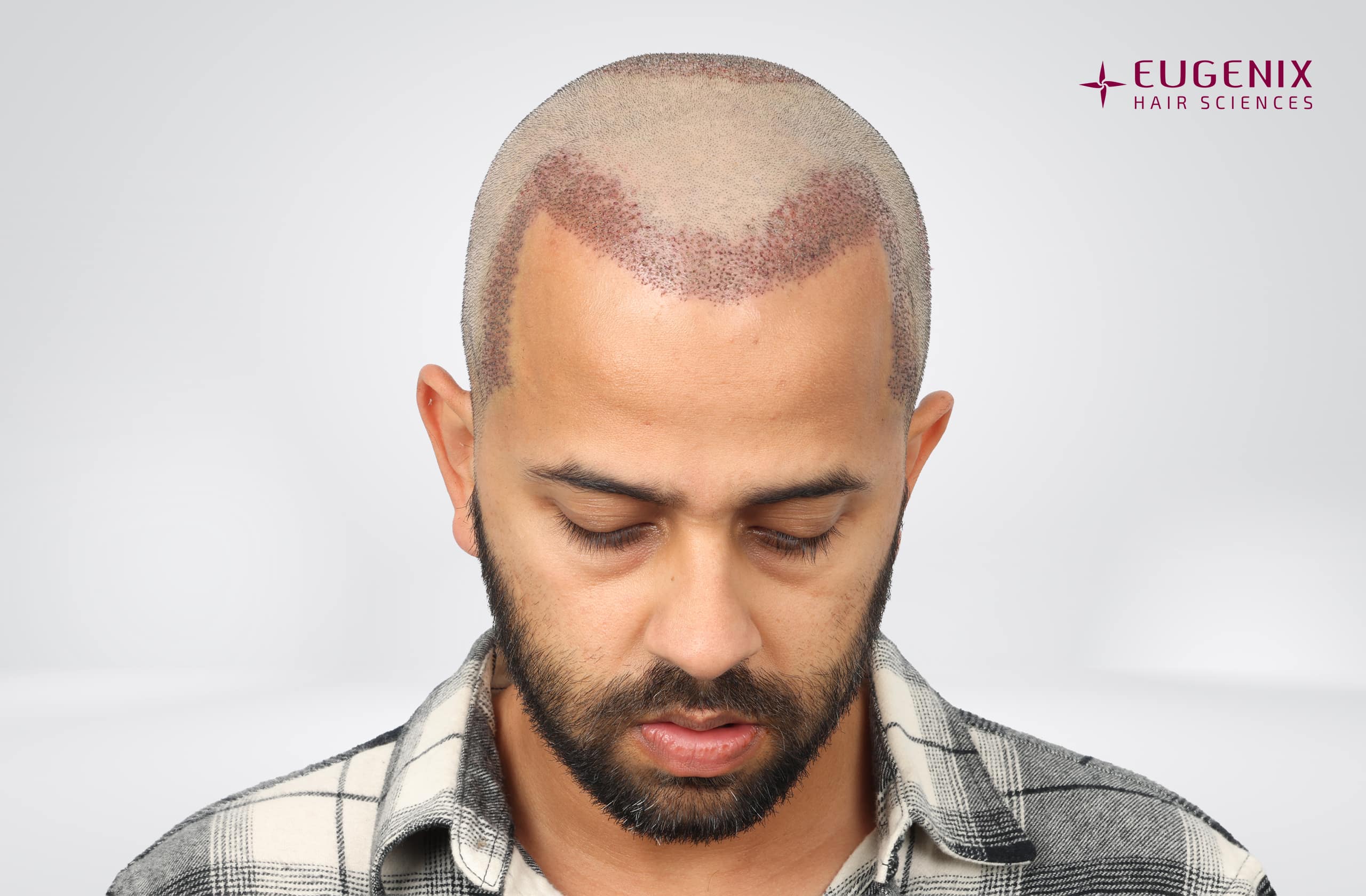 Mihir Gandhi Post-op Head Down copy