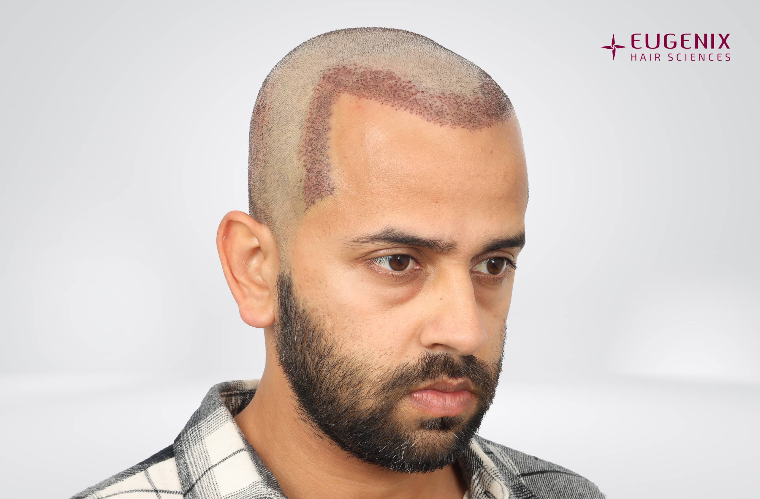 Mihir Gandhi Post-op Left copy