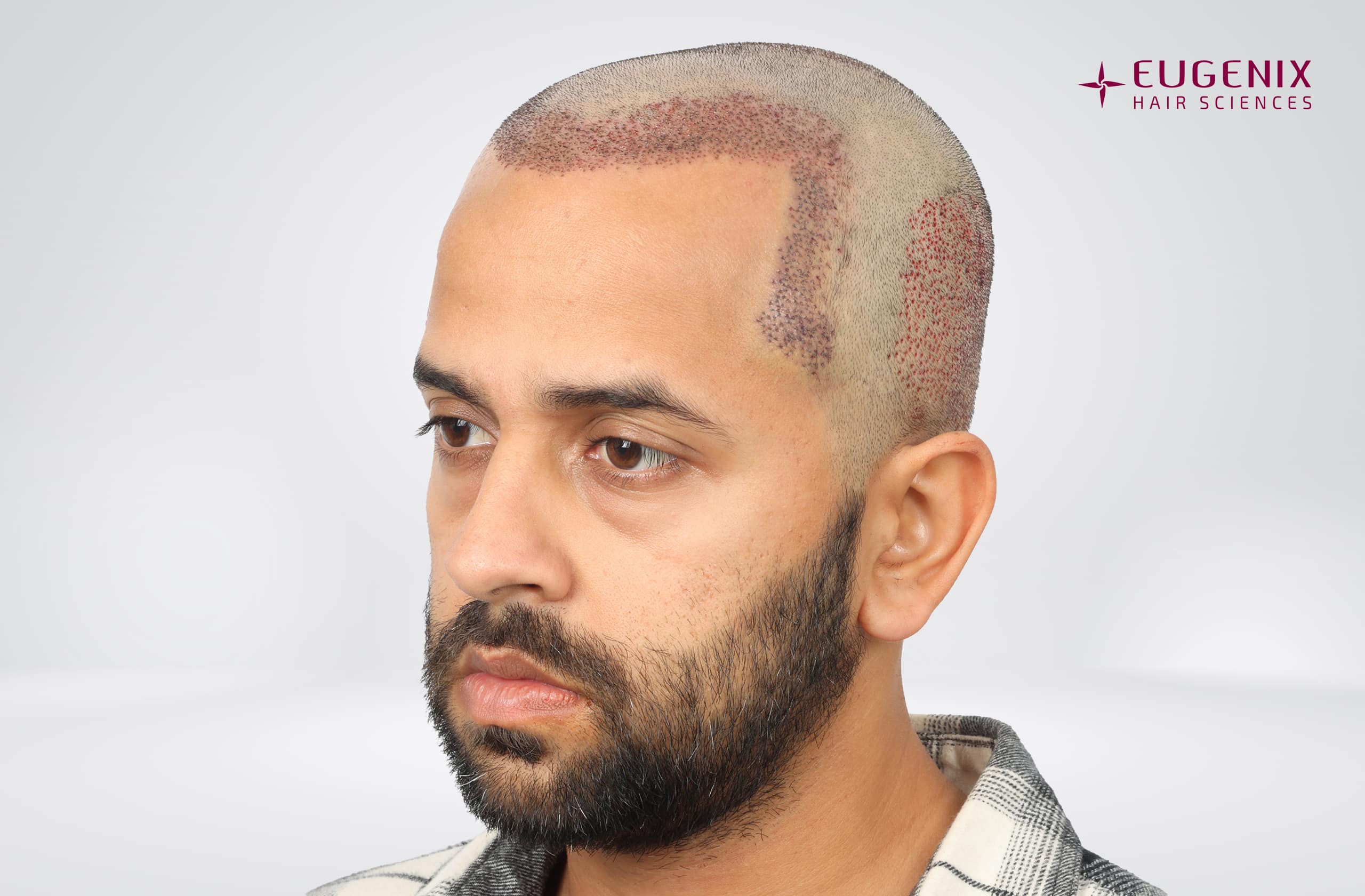 Mihir Gandhi Post-op Right copy