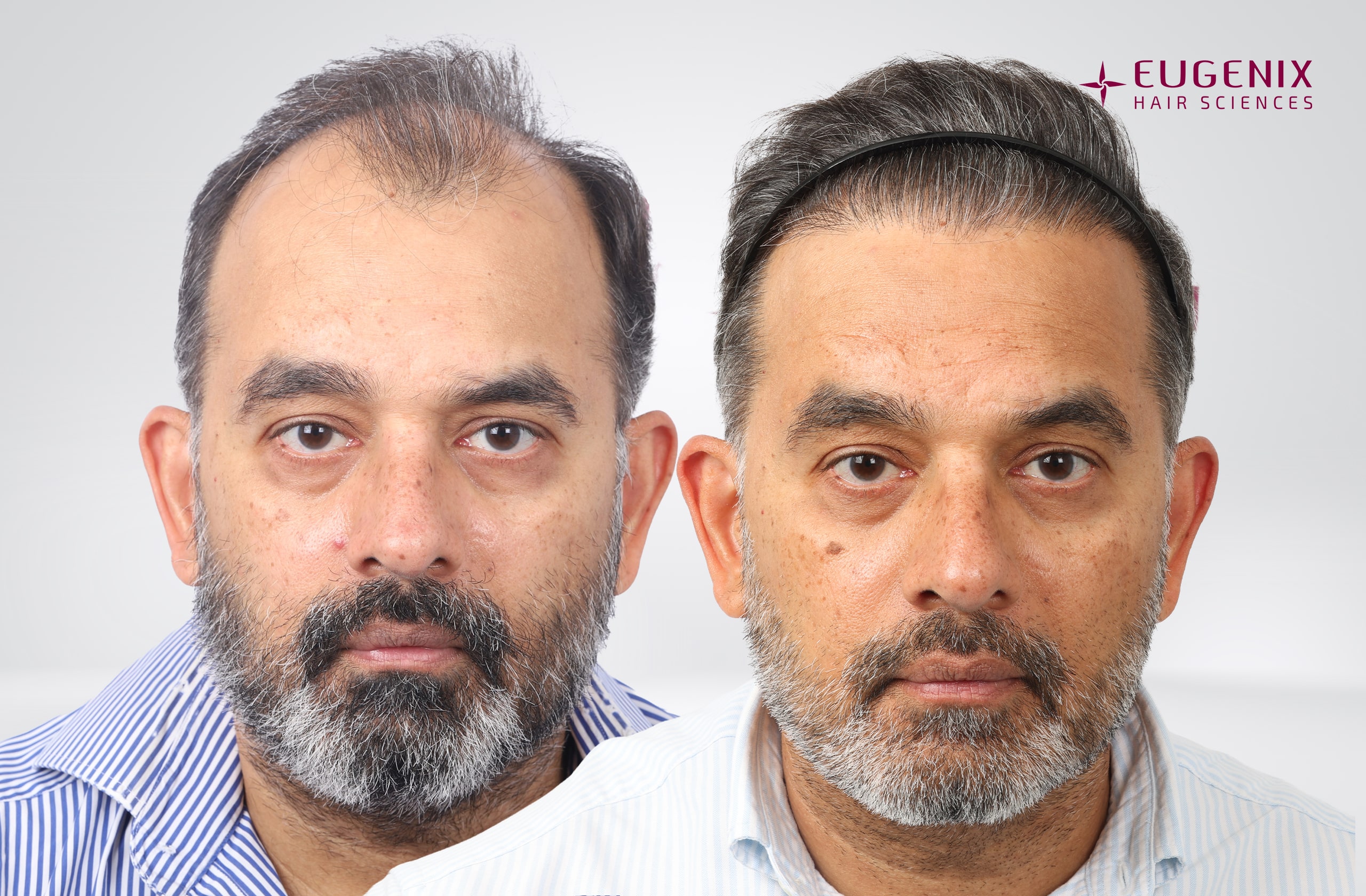 SHRAVAN SHROFF After and Before Front copy