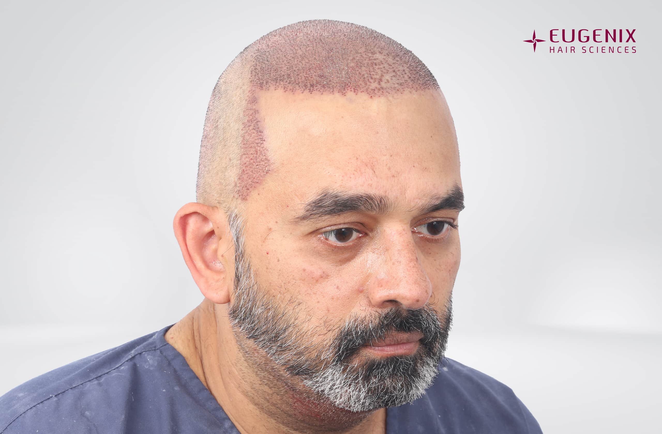 SHRAVAN SHROFF Post-op Left copy