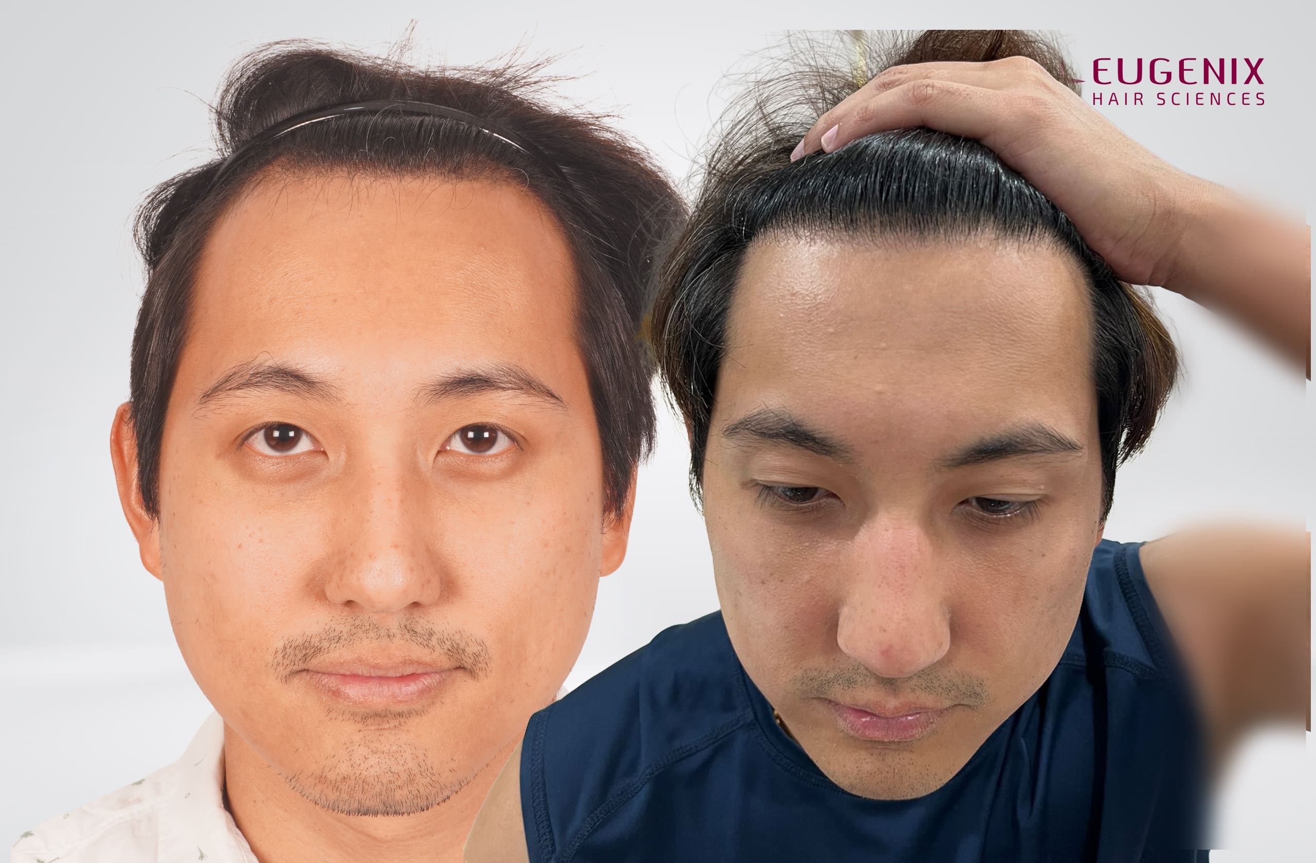Attapon Punnaravikit After and Before Front copy