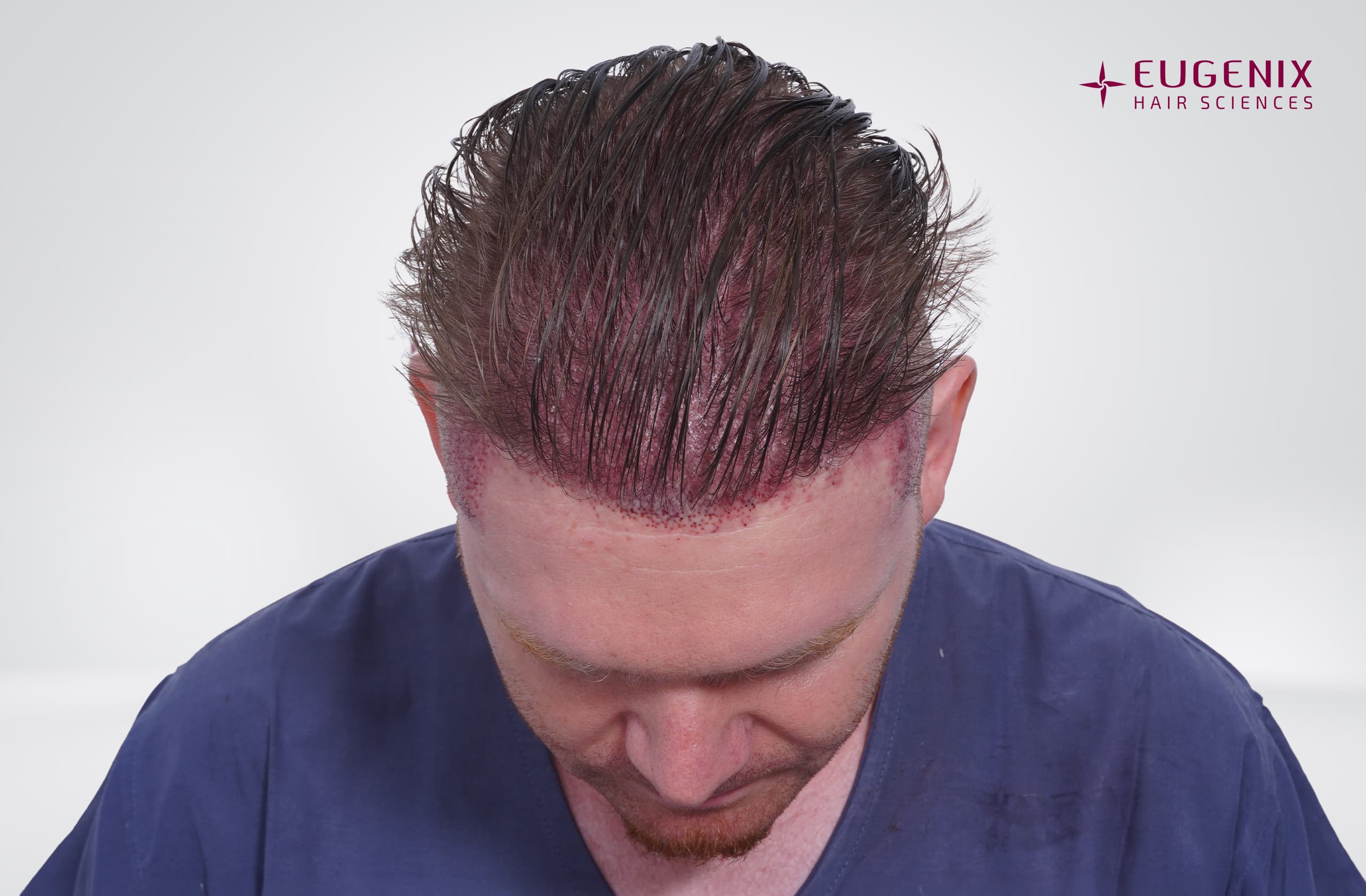 Henry Mogulsky Post-op Head Down copy