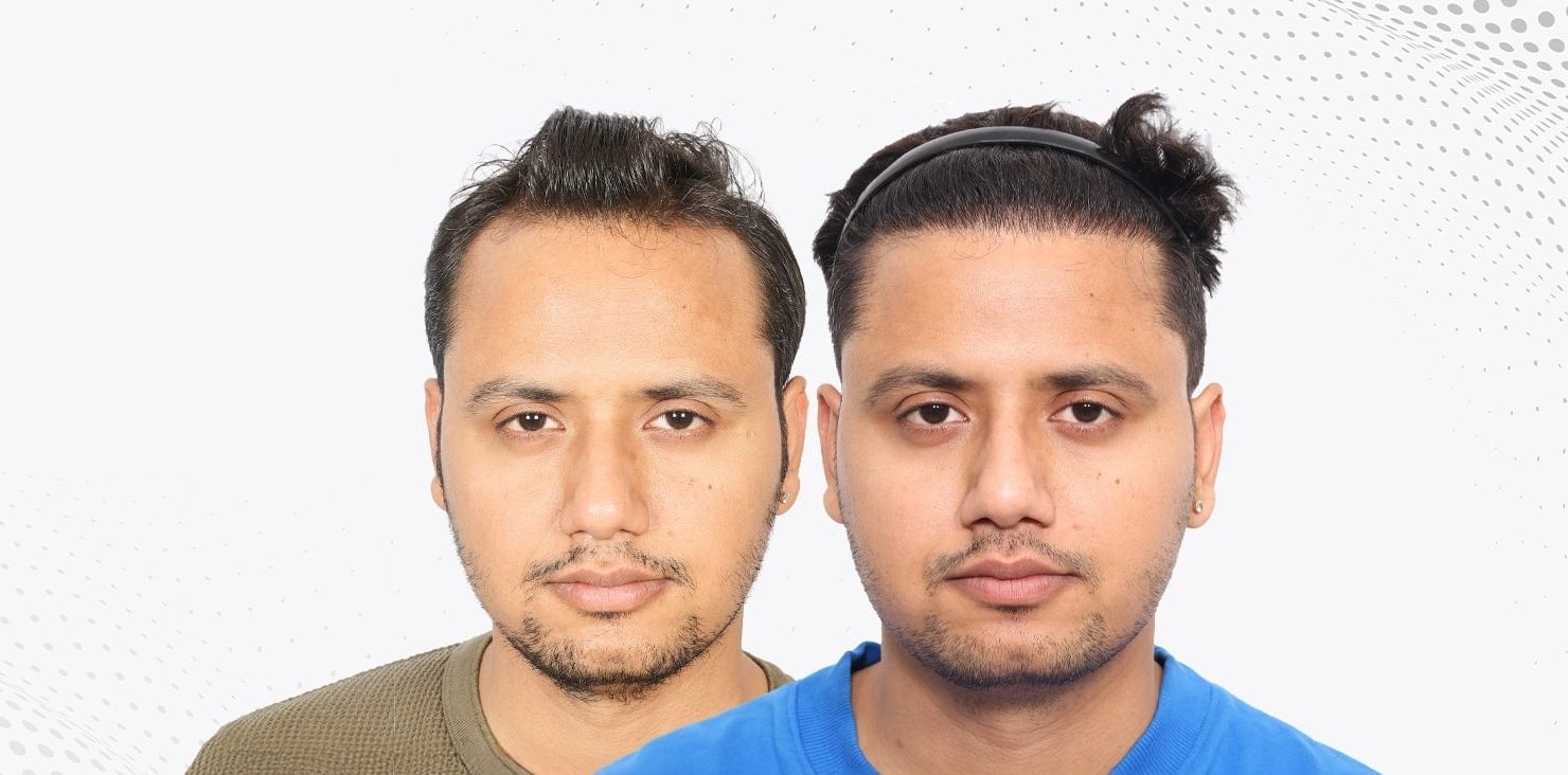 Why the Best Hair Transplants Are the Ones No One Notices!