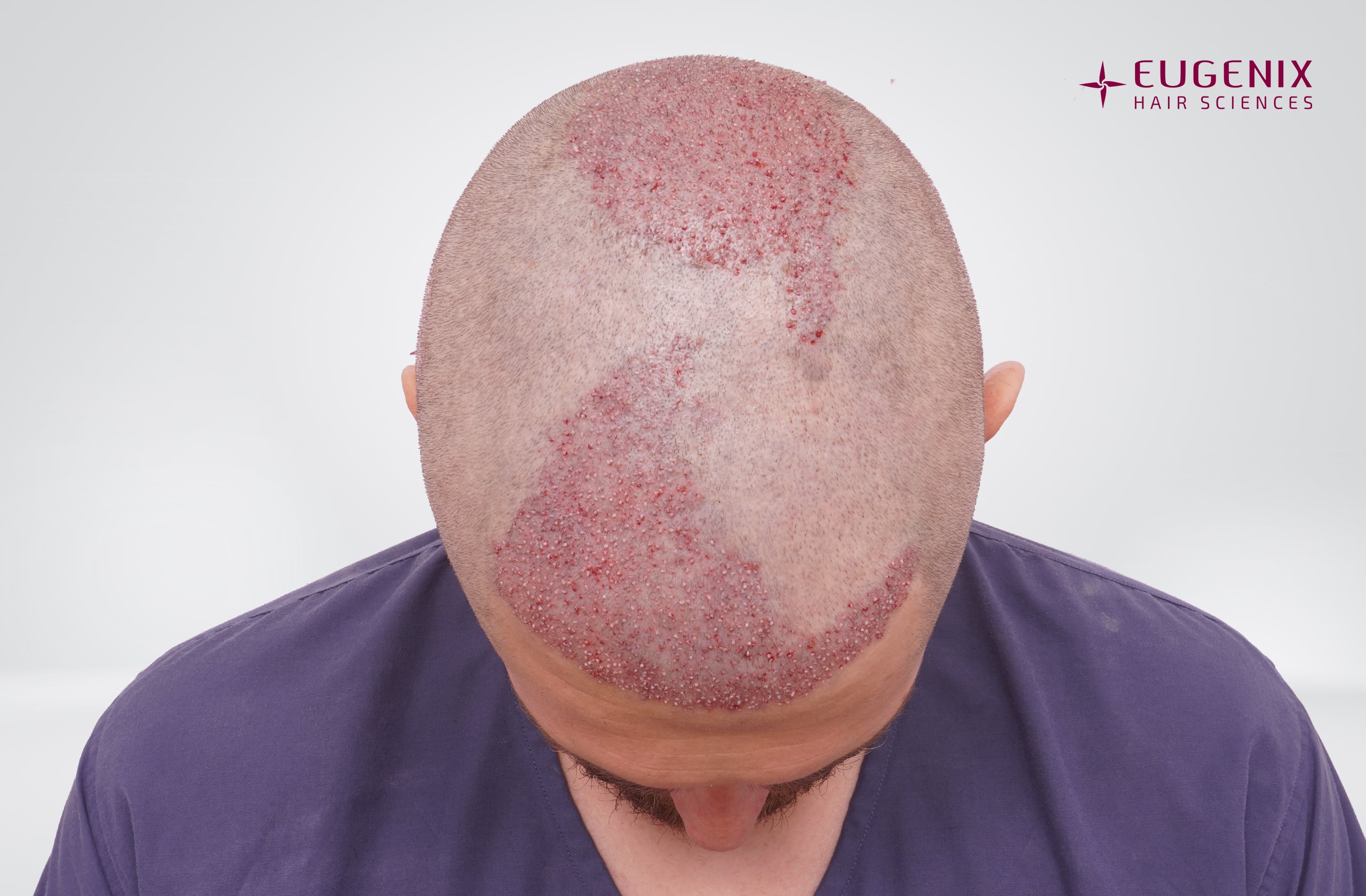 Mark Baker Post-op Head Down copy