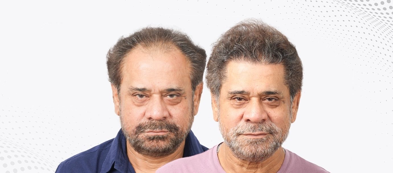 A Complete Guide to 4,000 Grafts Hair Transplant: Coverage, Donor Capacity & Results Expectations