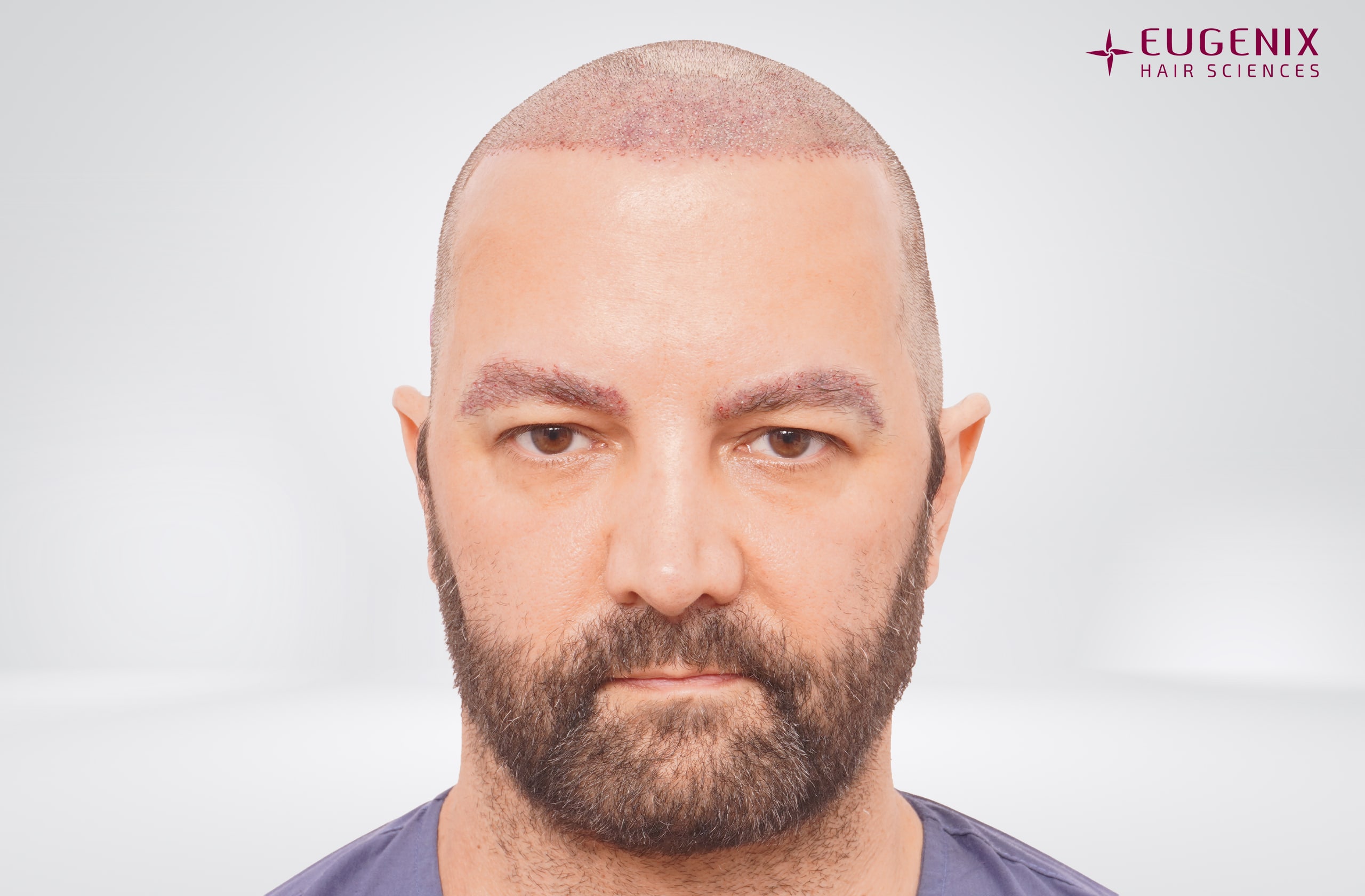 Anthony Monaco Post-op Front copy