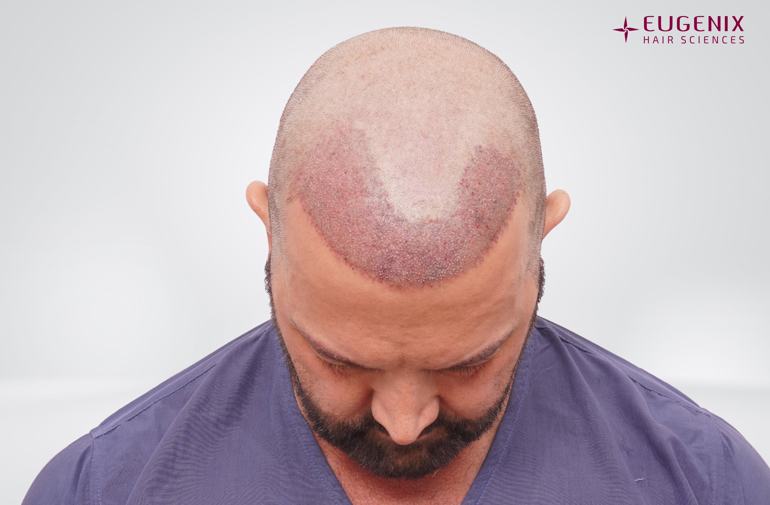 Anthony Monaco Post-op Head Down copy