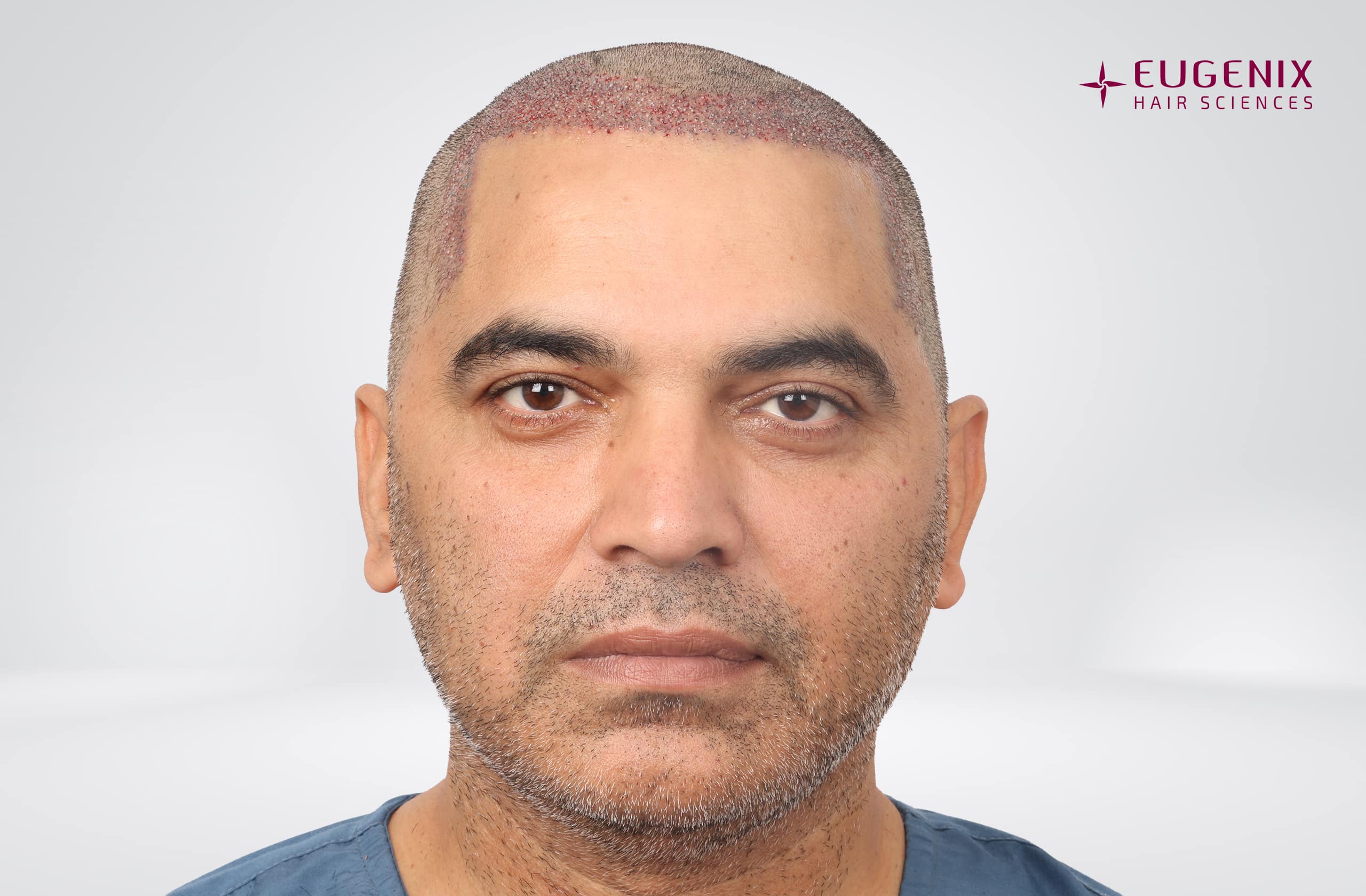 Nitin Dubey Post-op Front copy
