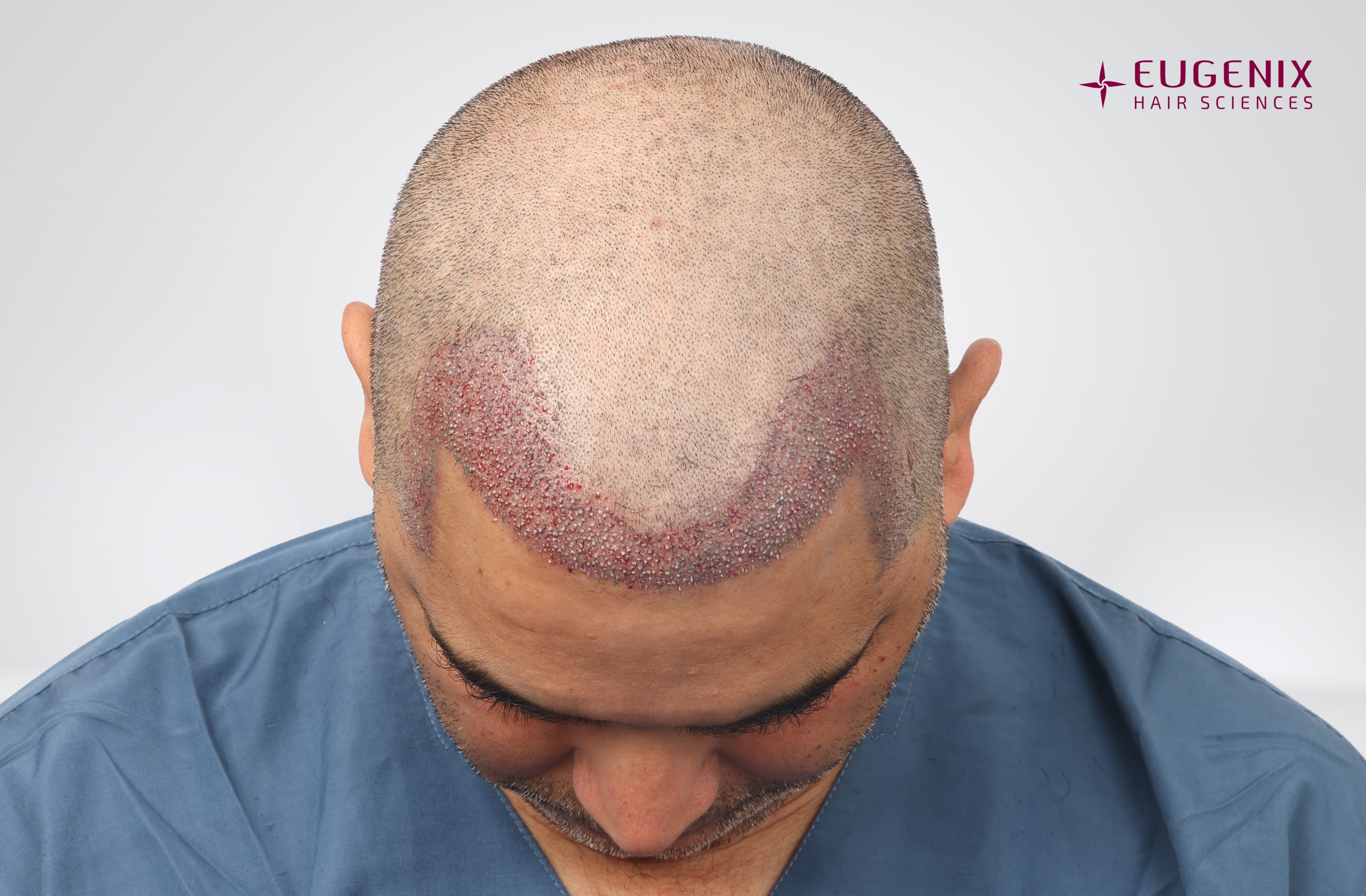 Nitin Dubey Post-op Head Down copy