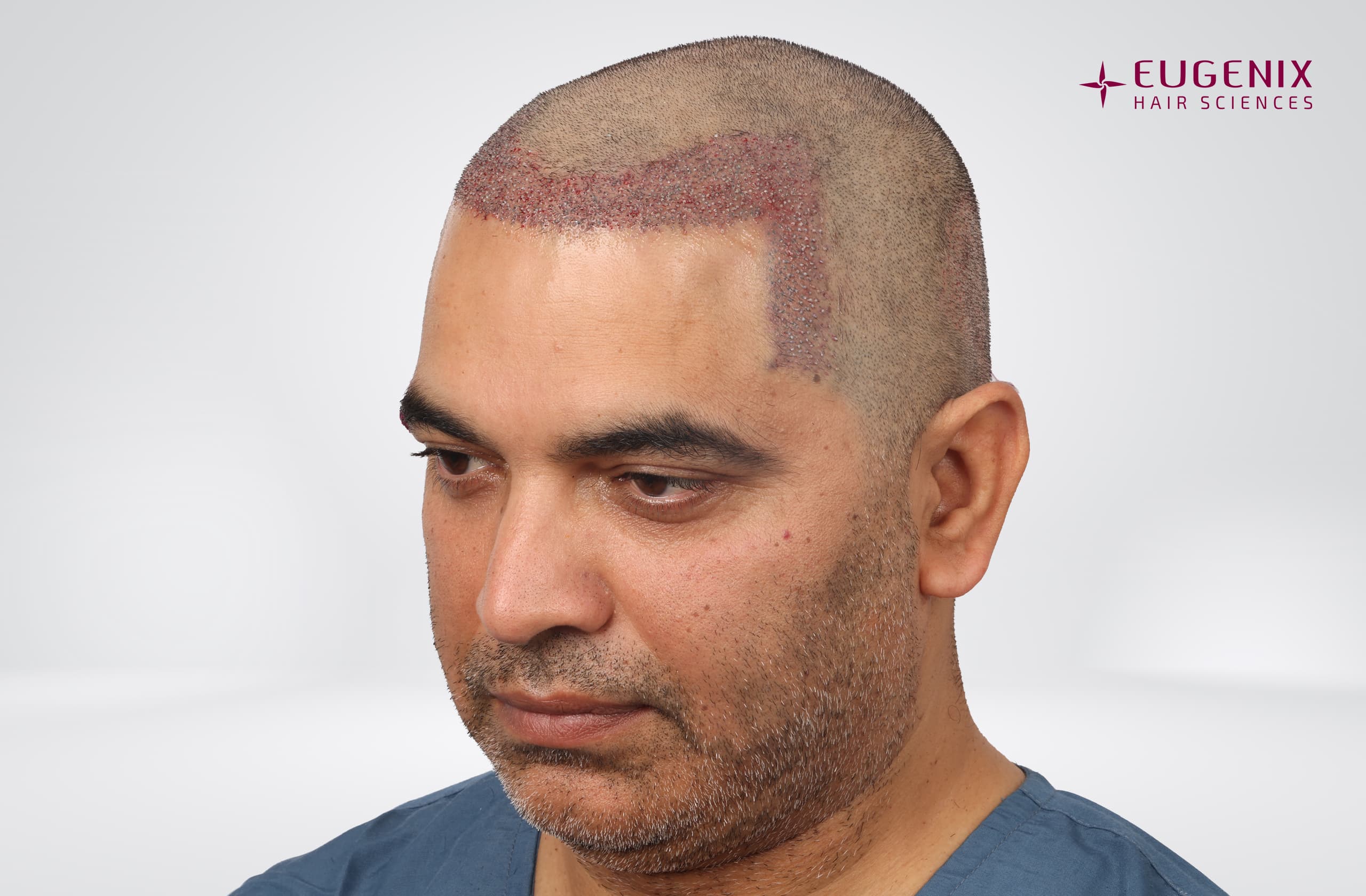 Nitin Dubey Post-op Right copy