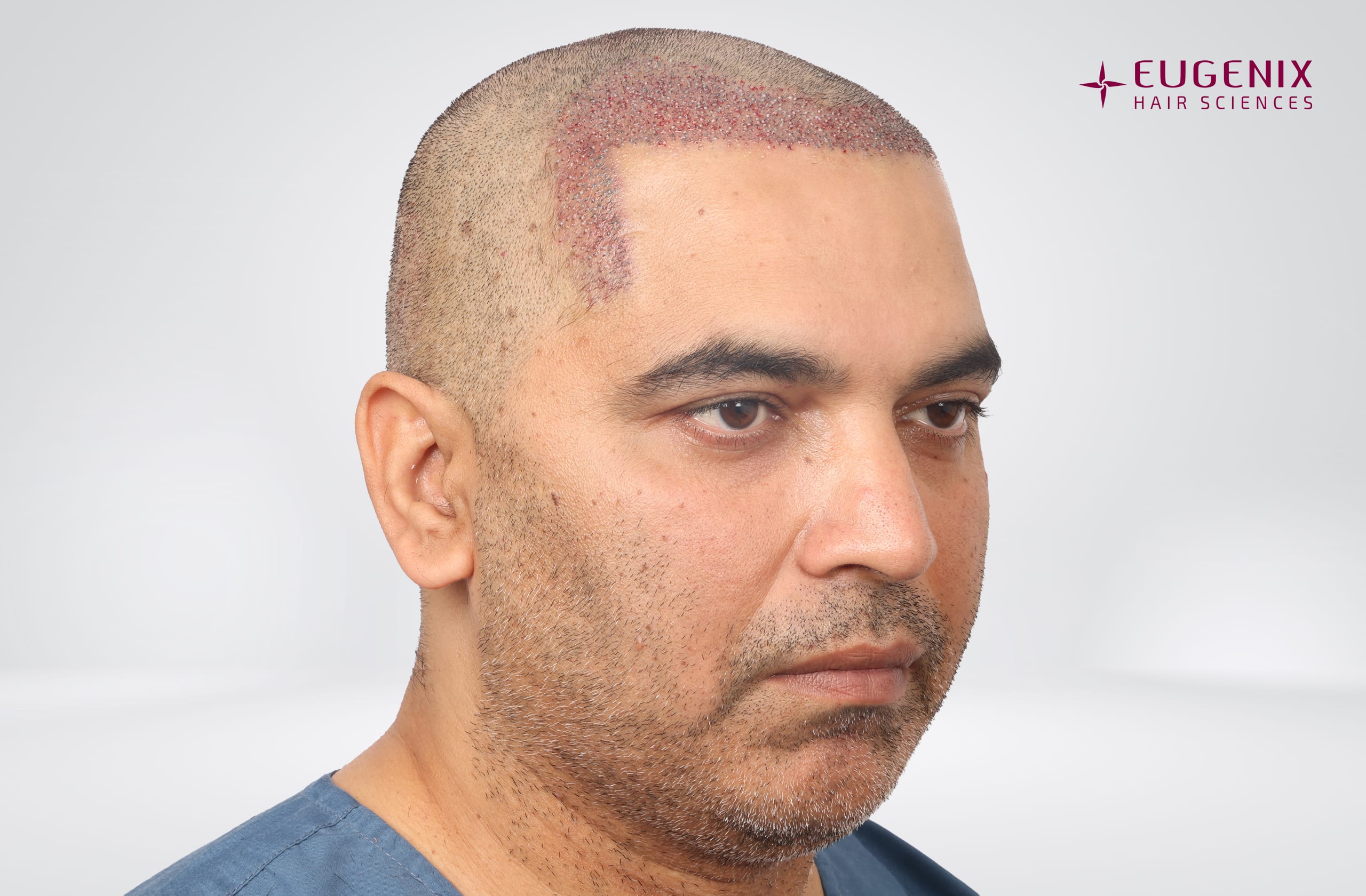 Nitin Dubey Post-op left copy