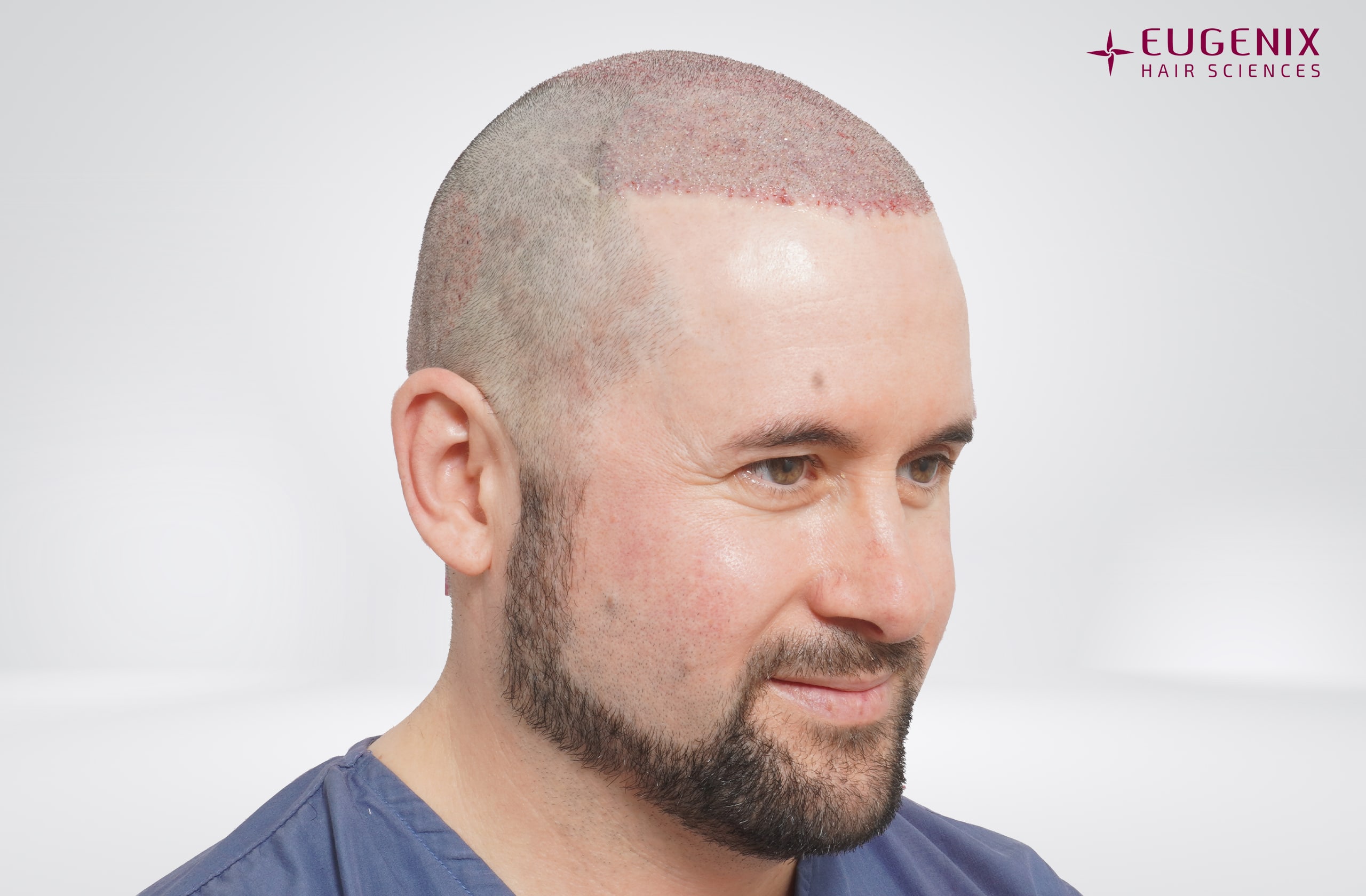 Thomas Wood Post-op Left copy