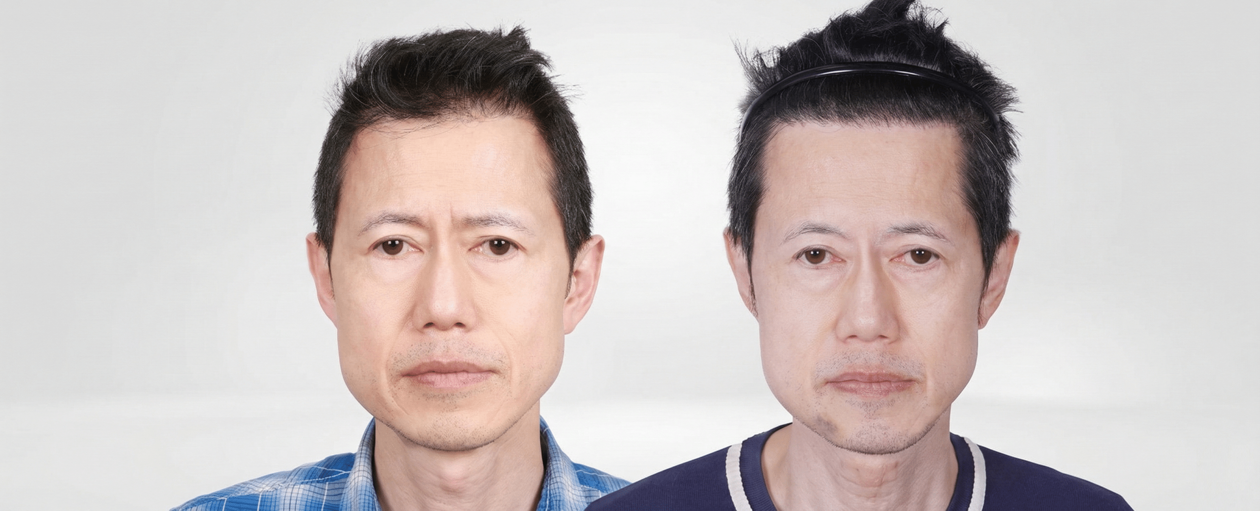 Caucasian Hair Transplant Repair: Correcting Pluggy & Unnatural Results