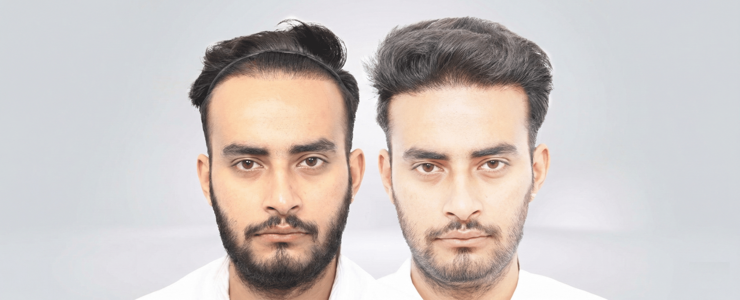 Hair Transplant Repair Surgery: Causes, Solutions and Real Results