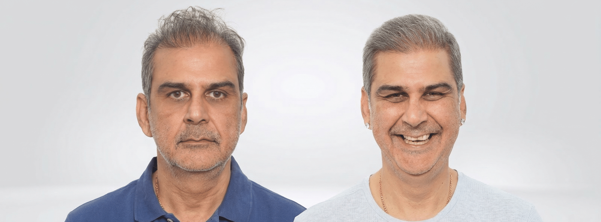 A Complete Guide to 6,000 Grafts Hair Transplant: Coverage, Donor Capacity & Results Expectations