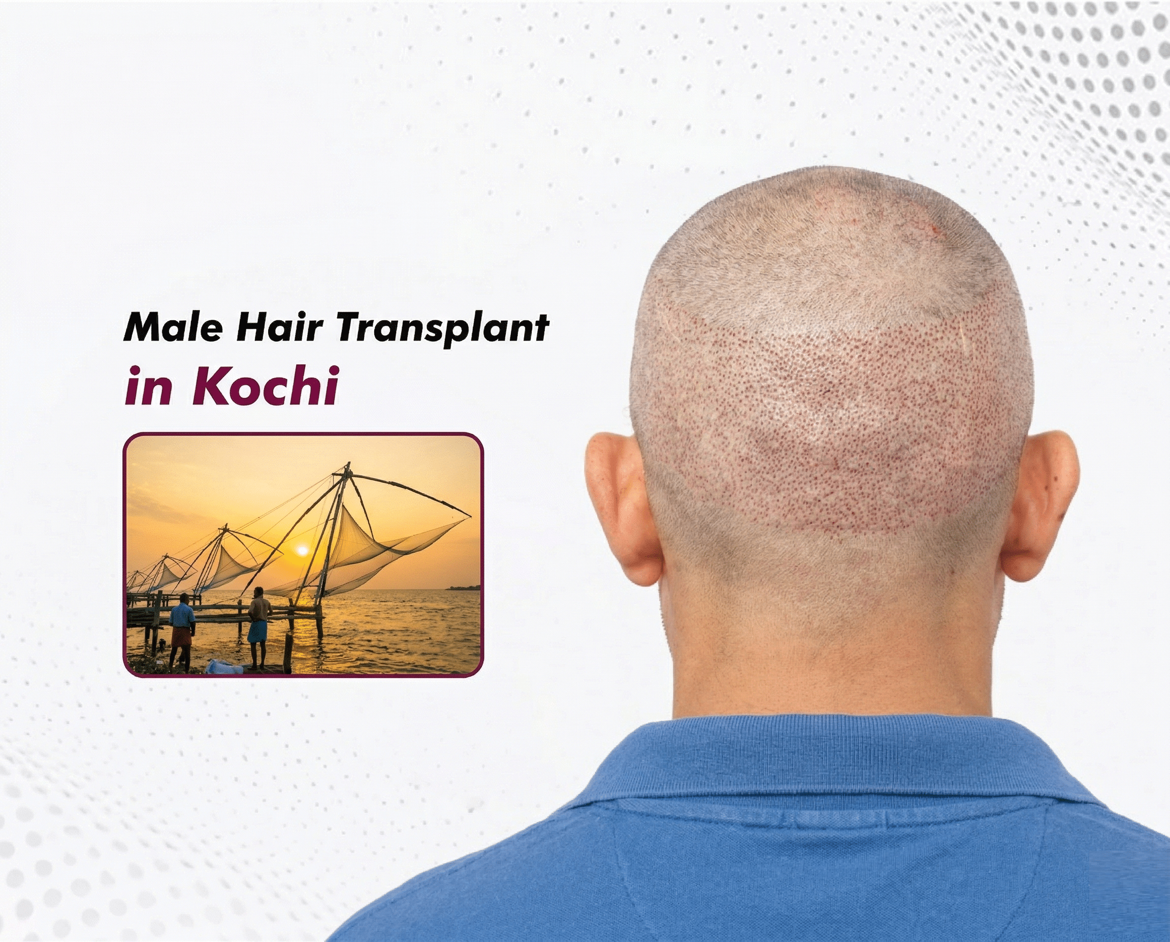 male-hair-transplant-in-kochi