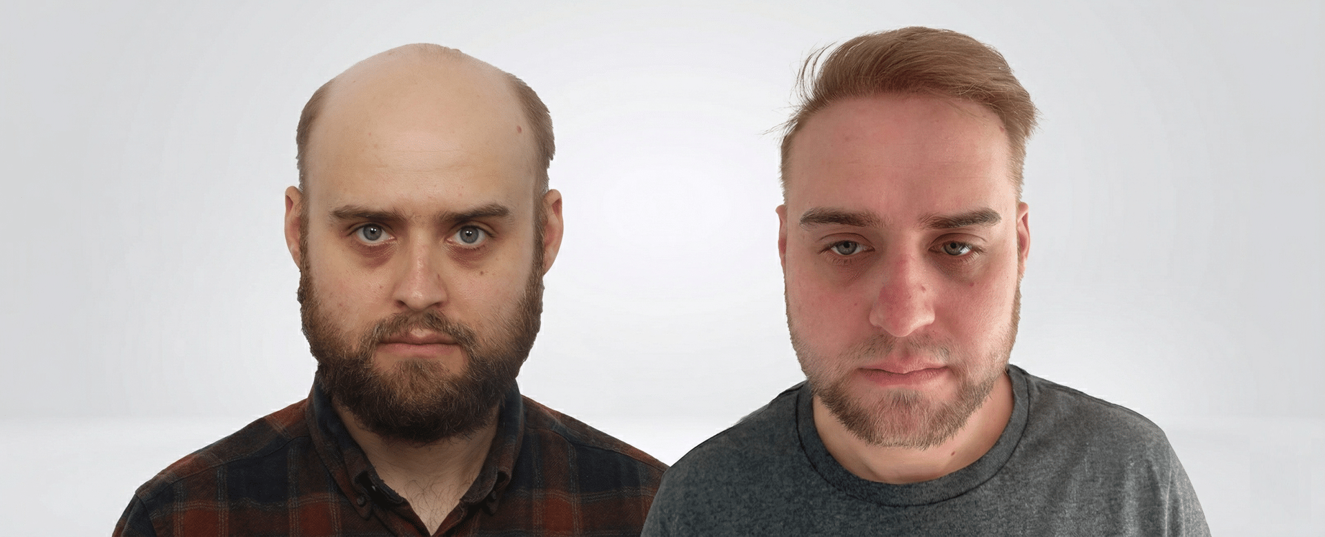 A Complete Guide to 8,000 Grafts Hair Transplant: Coverage, Donor Capacity & Results Expectations