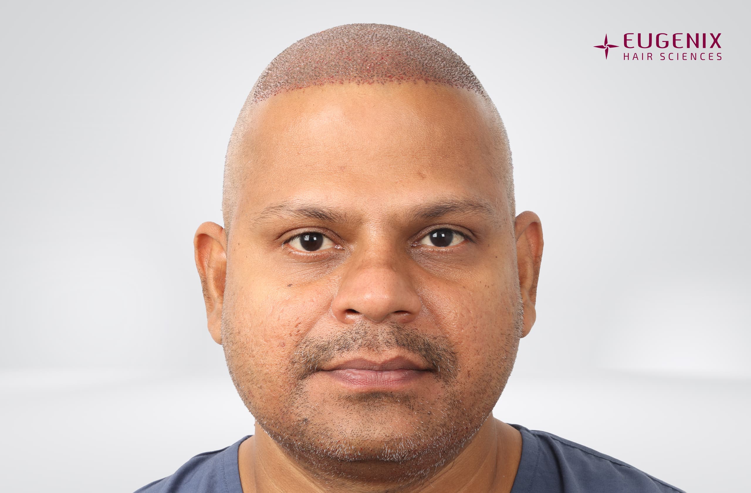 Rakesh Singh Rathore Post-op Front copy