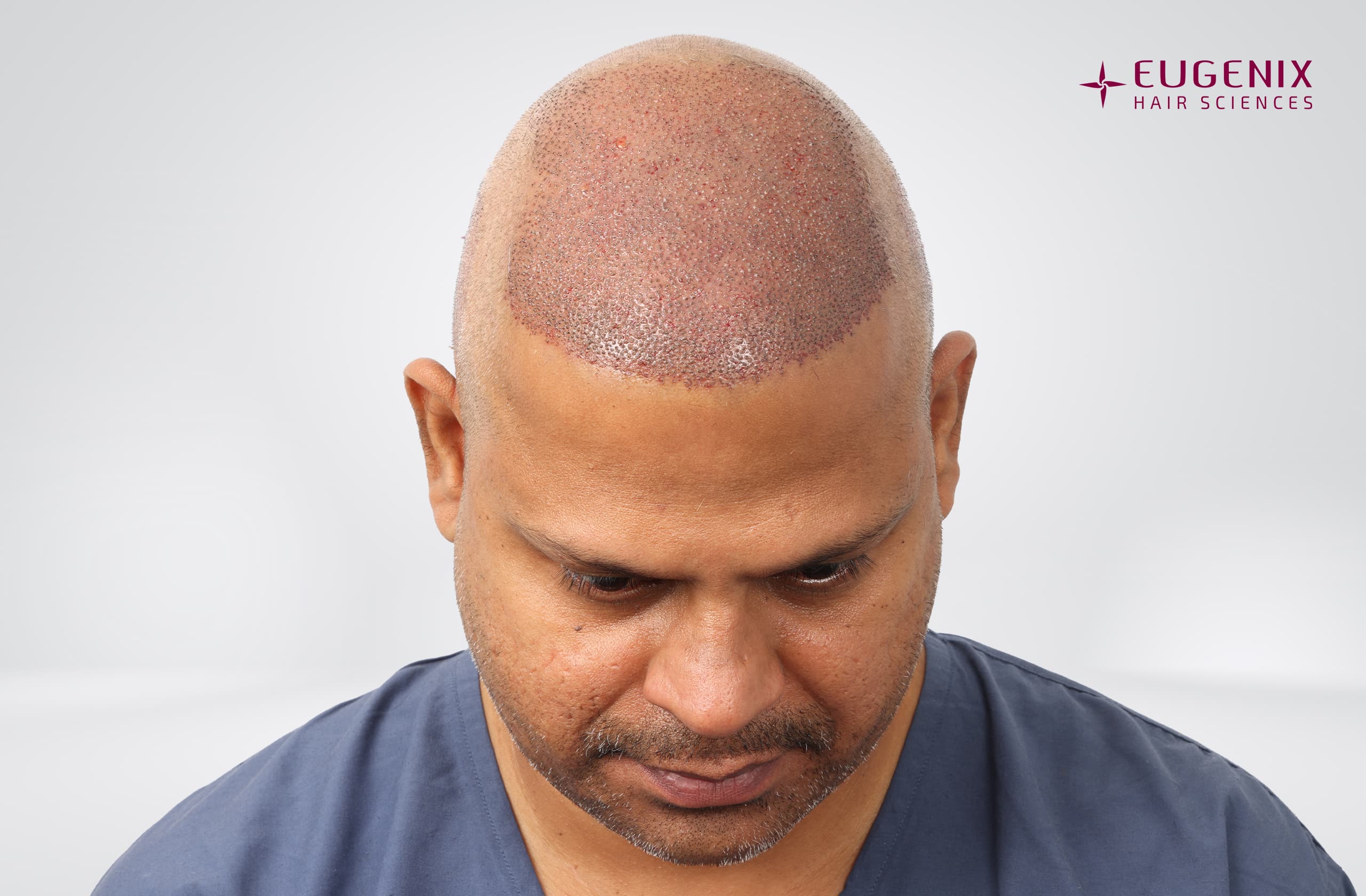 Rakesh Singh Rathore Post-op Head Down copy