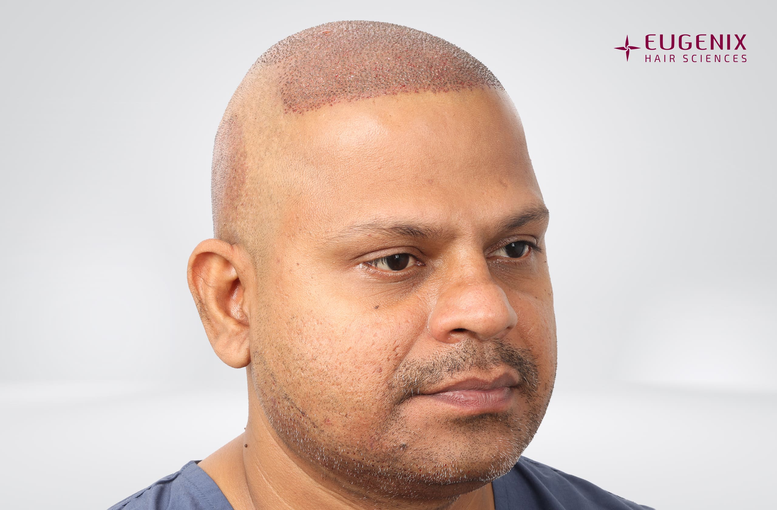 Rakesh Singh Rathore Post-op Left copy