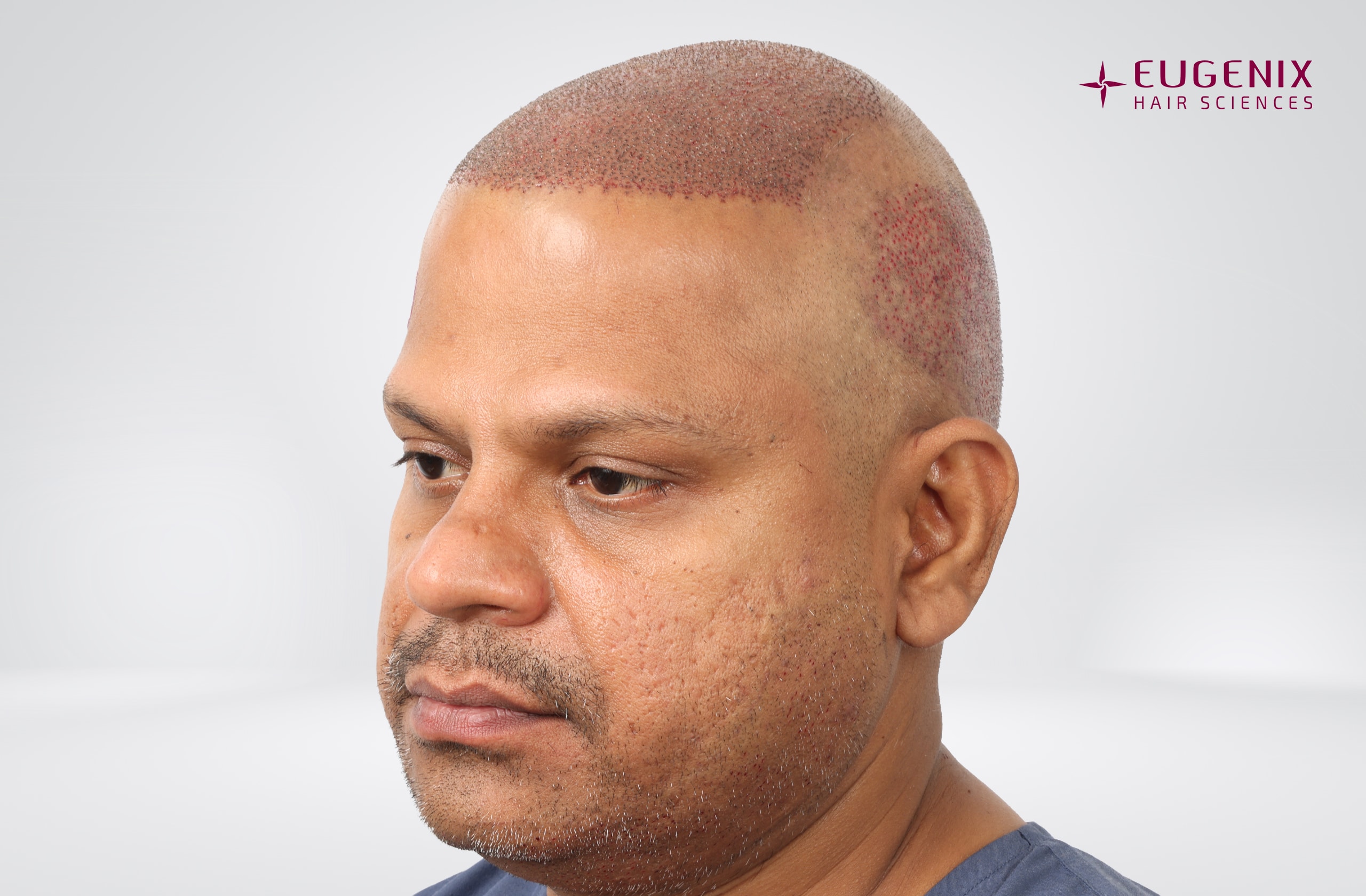 Rakesh Singh Rathore Post-op Right copy