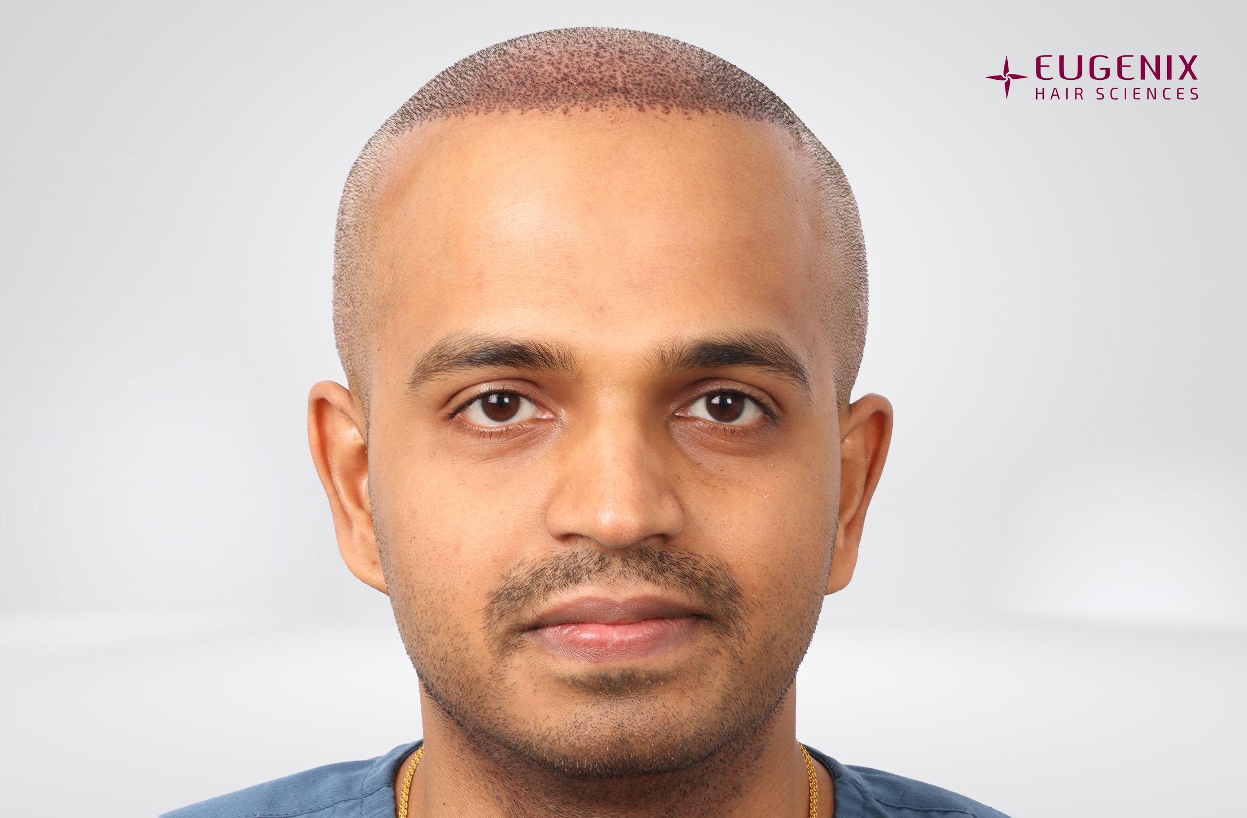 Sanket Sanjay Achari Post-op Front copy